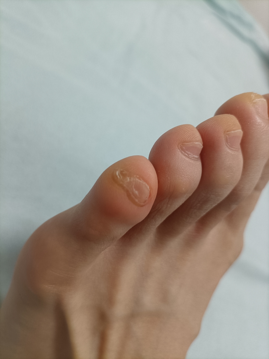 这双脚是不是没救了[捂脸][捂脸][捂脸],严重拇外翻不说,小拇指的指甲