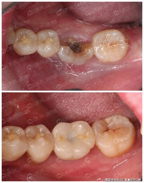 我妈四颗大牙被虫蛀了没去修补