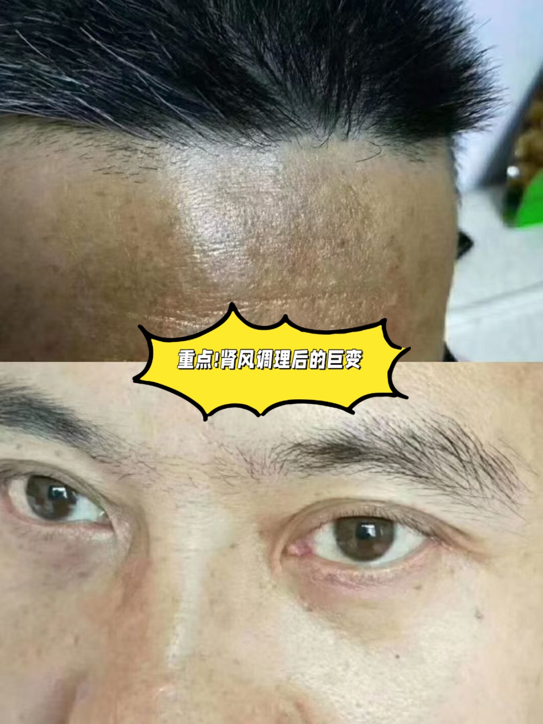 风者,善行而数变,为百病之长 肾风:多汗恶风,头
