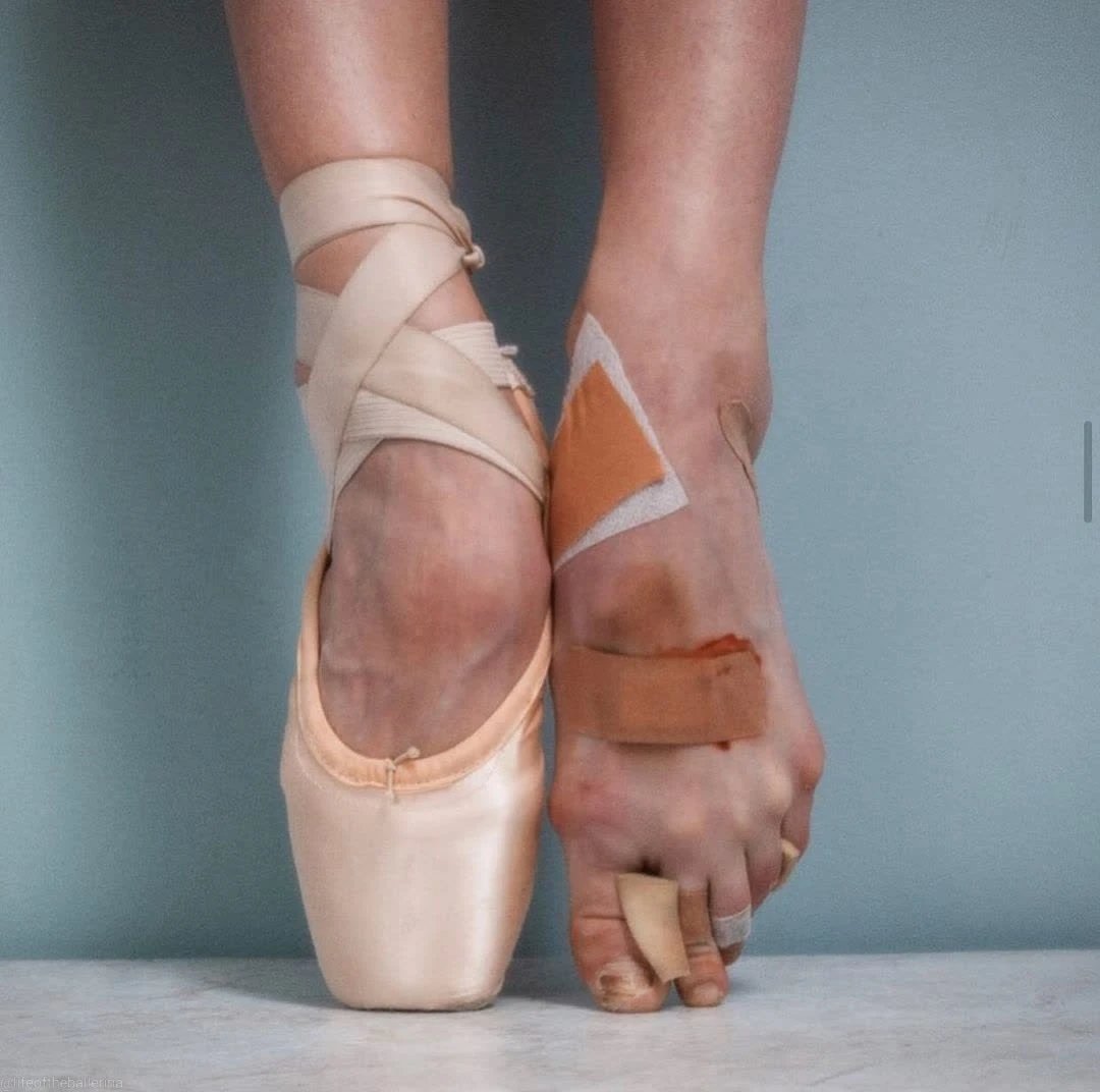 任何苦姚安娜跳芭蕾的脚趾受伤华为芭蕾伤痕累累的照片舞蹈脚对比励志
