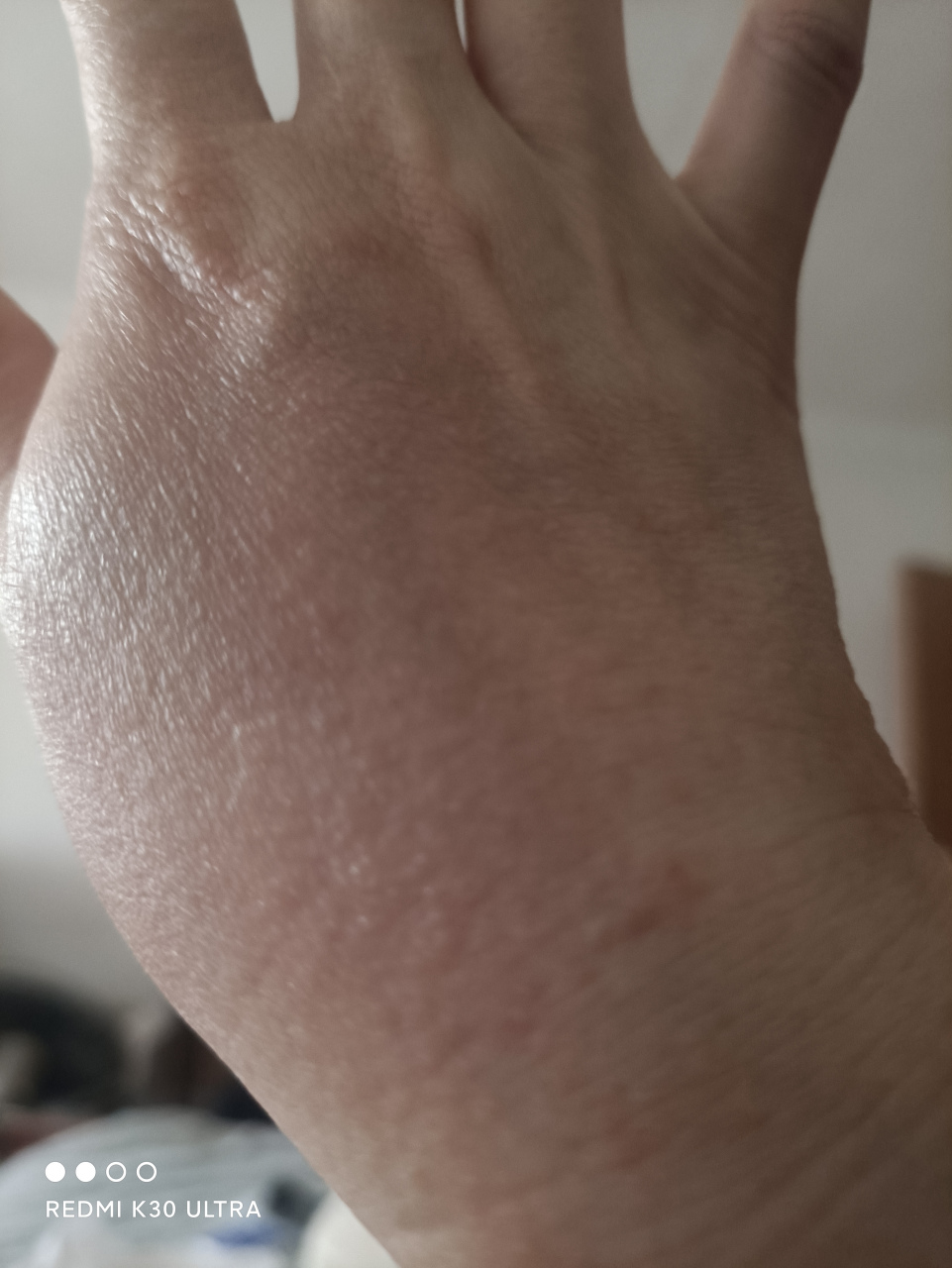 手上出了密密麻麻的小疙瘩,手心手背都有,刚开始不明显,只是比较痒