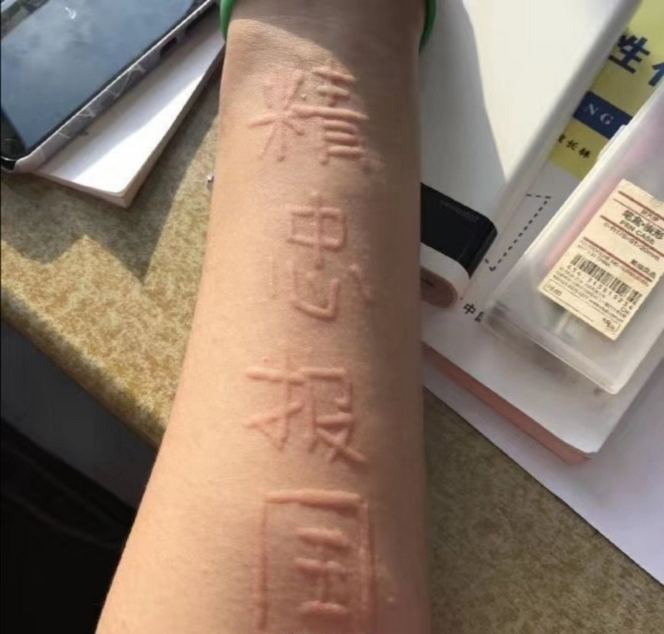 深圳肤康皮肤科#稀奇古怪的过敏体质:皮肤划痕症   荨麻疹的一种,又