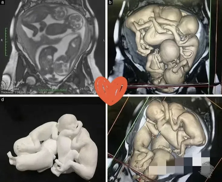 四胞胎原来在肚子里这样的,看起来有点挤