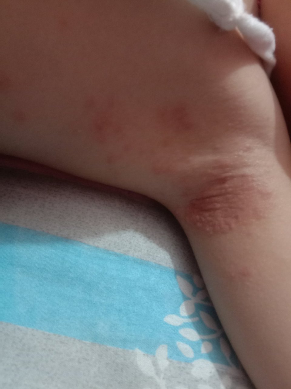 三岁孩子腋下长些这样的红点点,亲们有谁知道这是什么皮肤病,请告知.