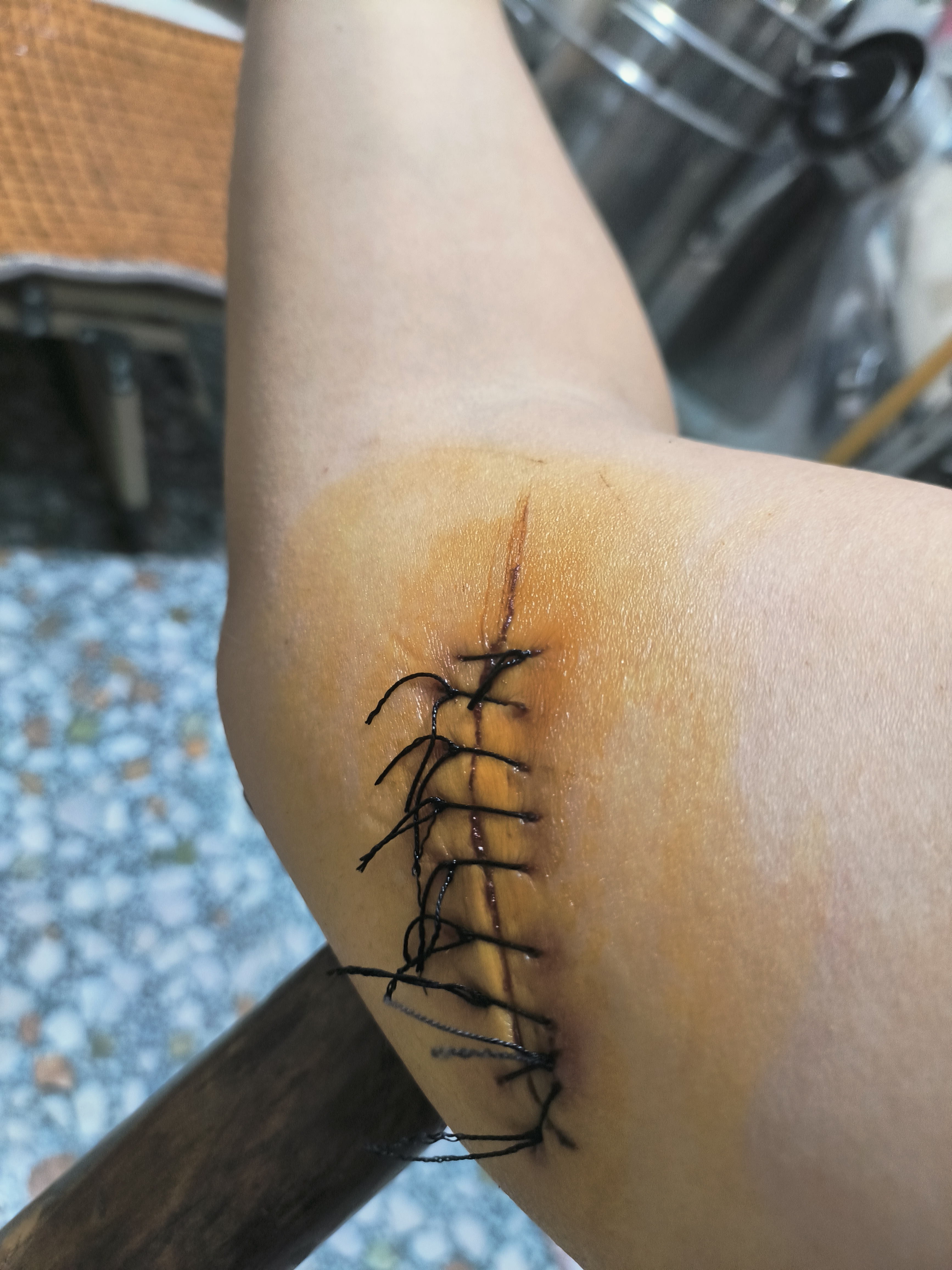 伤口为什么会痒呢怎么回事为什么在线 伤口为什么会痒呢怎么回事为什么在线