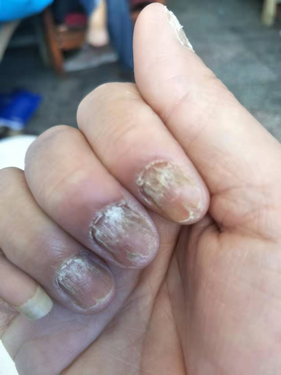 甲扁平苔藓,口服维a酸片10mg两个月恢复正常