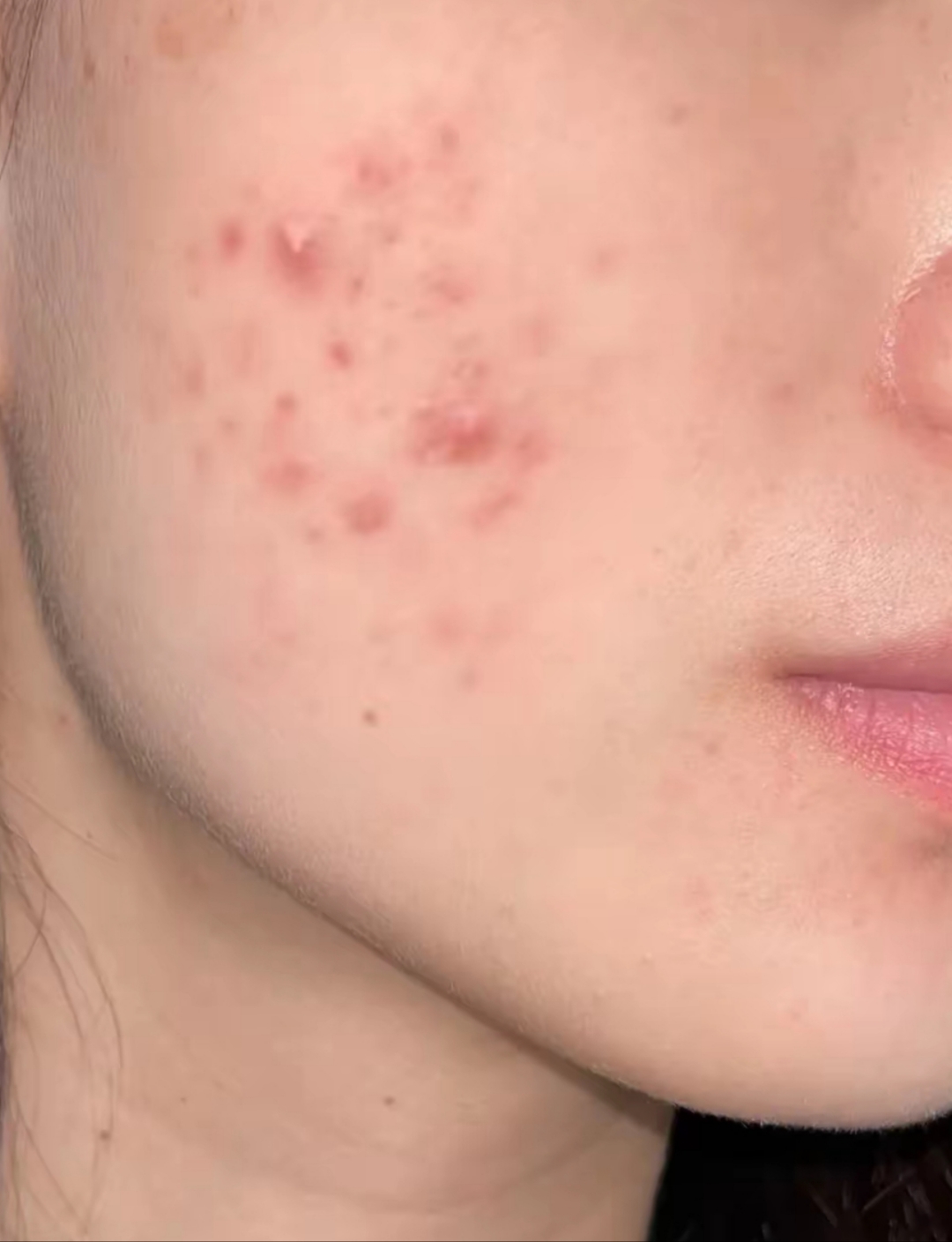 这痘痘反反复复的.各种方法都试了个遍