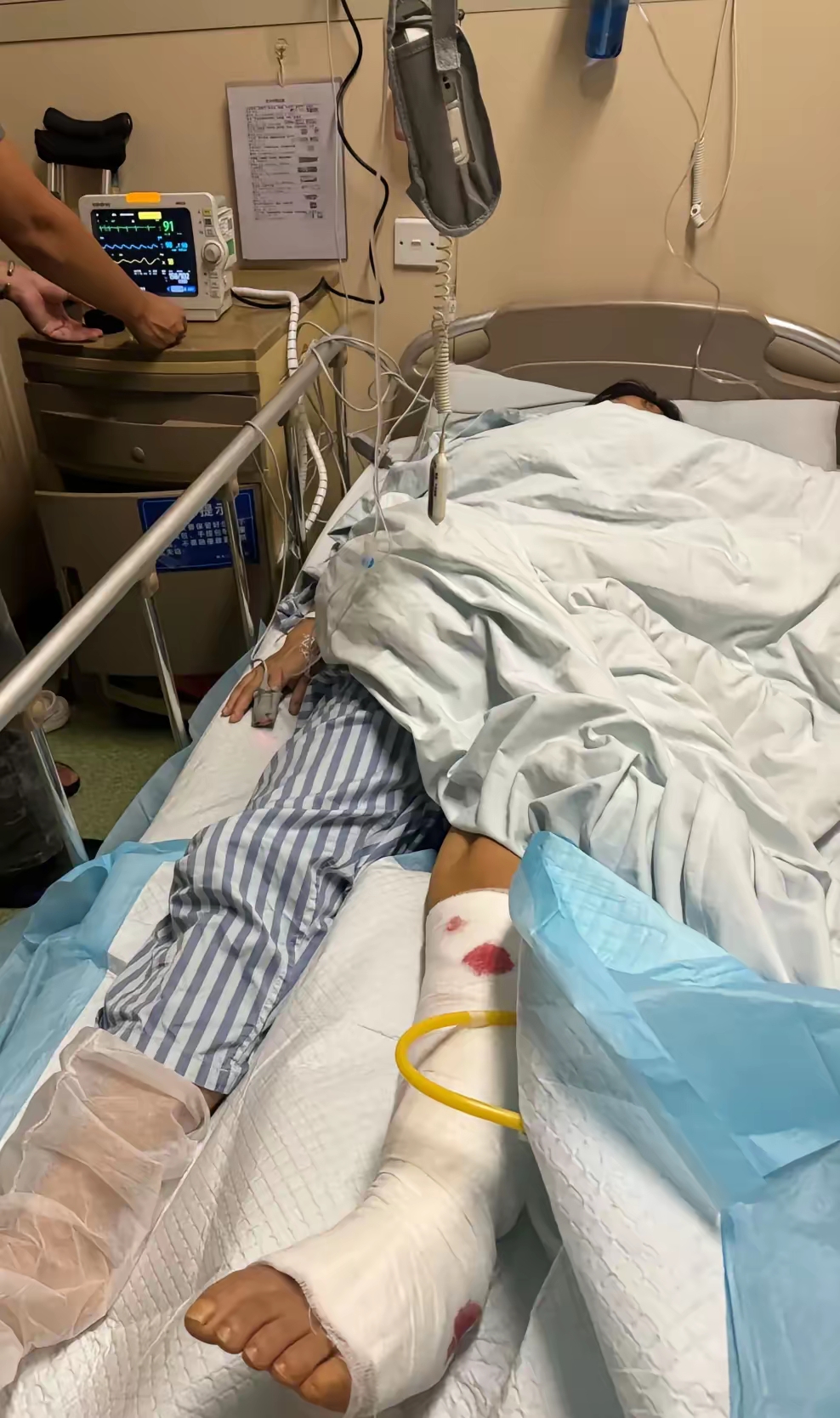 我老婆坐月子,我妈既然出去旅游,路上出车祸,腿给