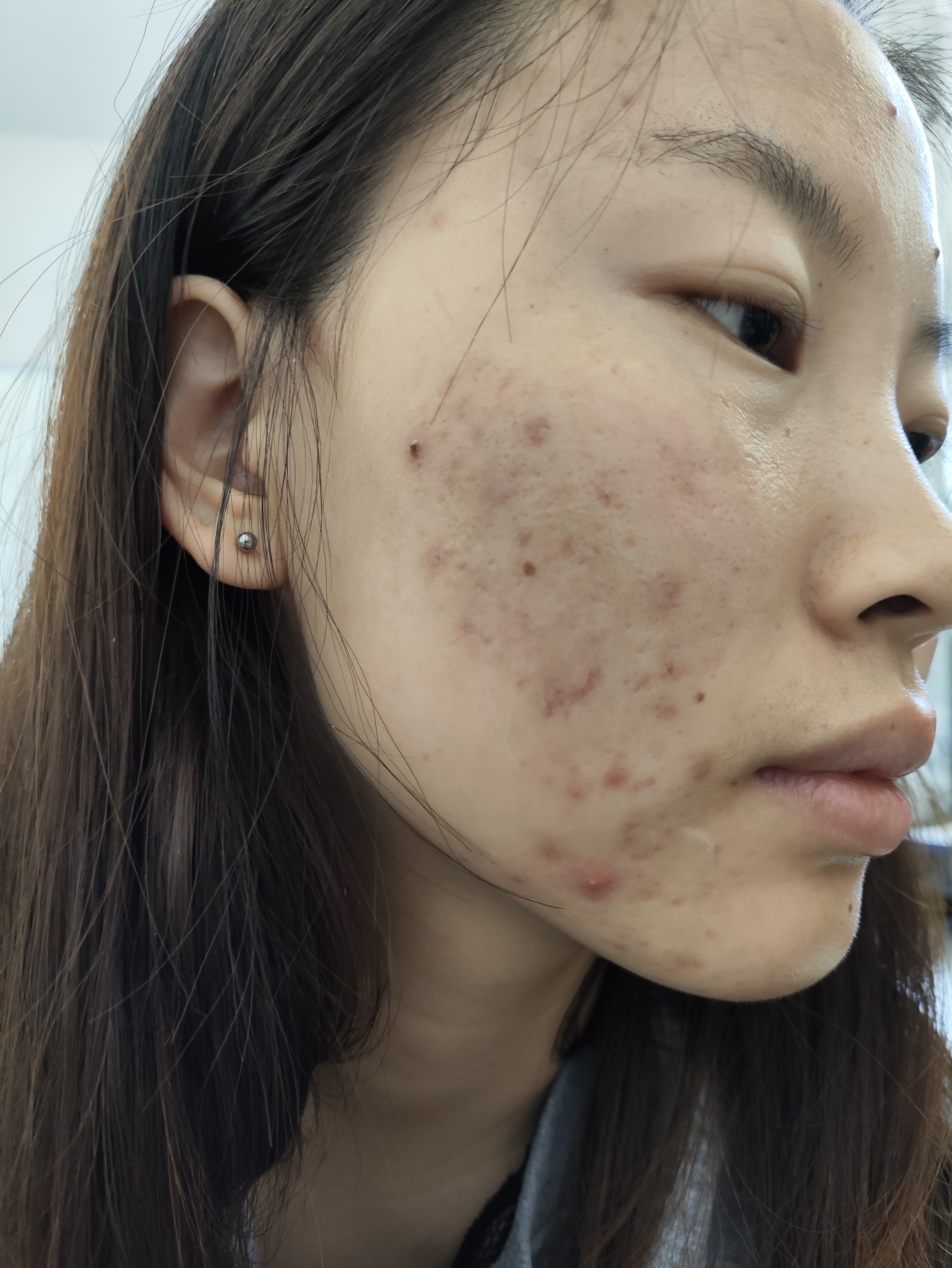 姐姐你的脸上怎么那么多痘痘,我破防了#敏感肌 #修复激素脸 #拯救敏感