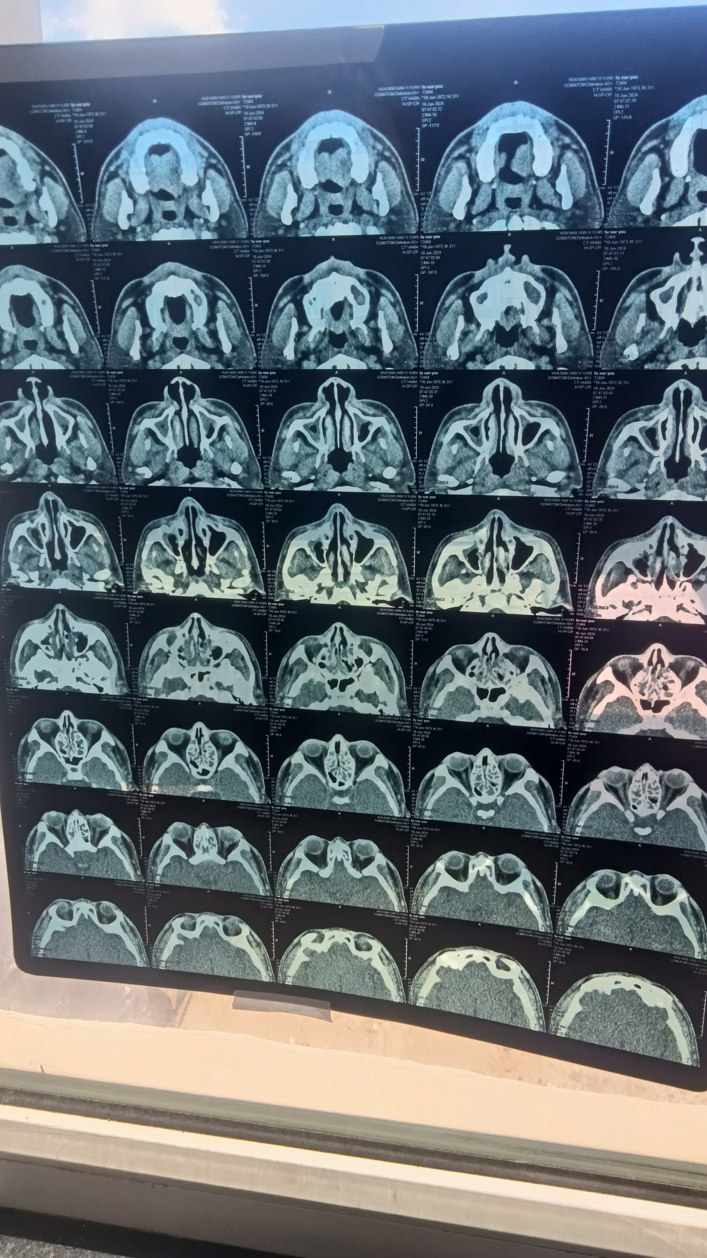 有那位鼻科专家能给我帮忙看下片子.