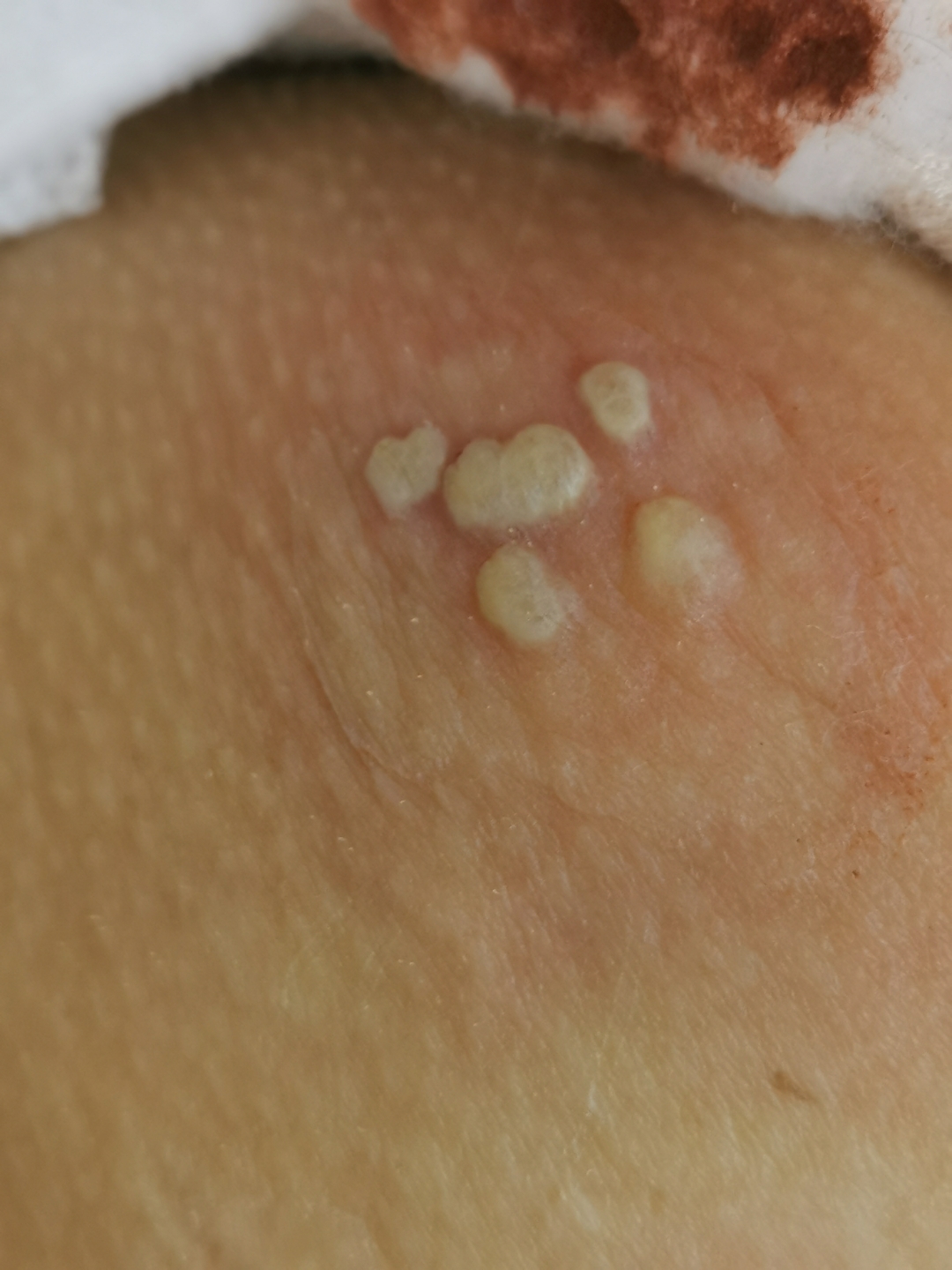 这东西是长在屁臀部上,刚开始是有点像长了痱子一