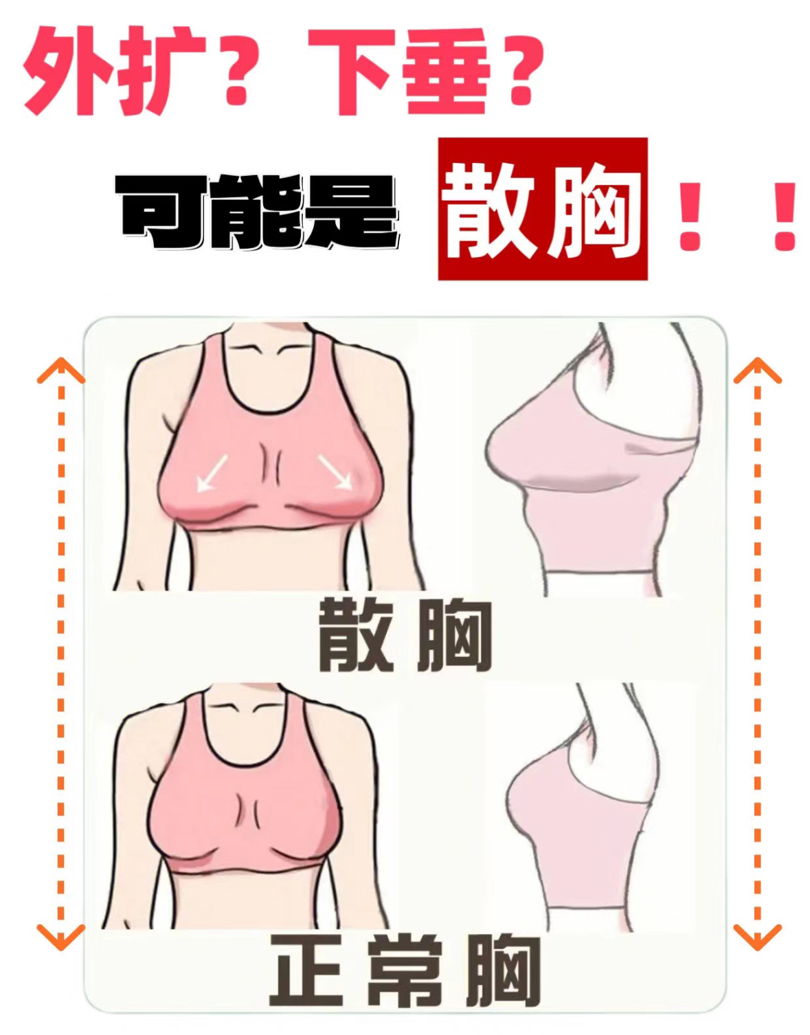 乳房外上象限图片