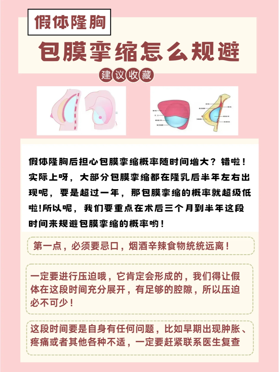 假体隆胸包膜挛缩表现图片