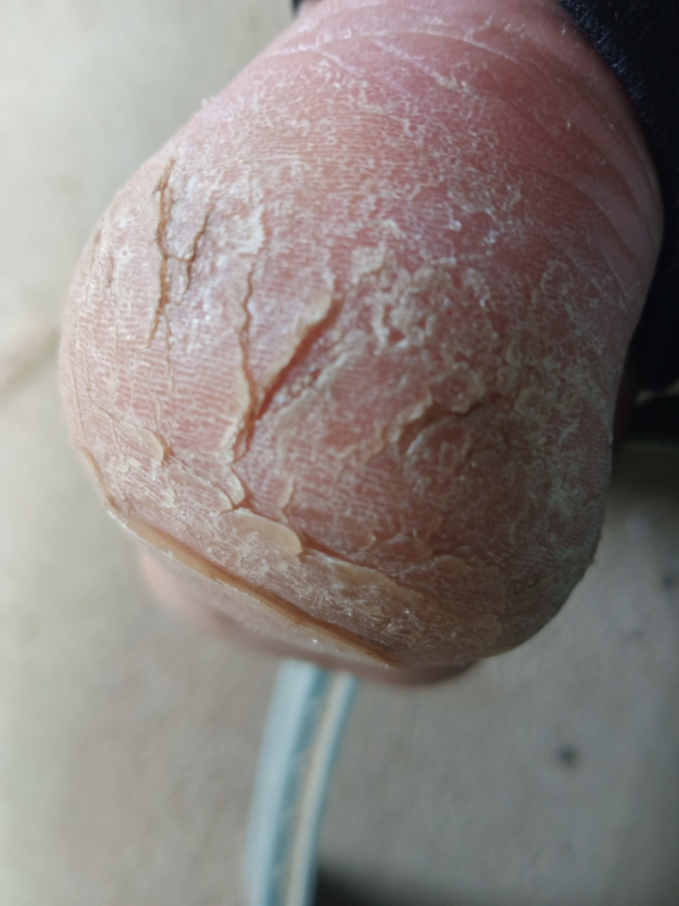 身体乳可以治脚后跟开裂吗（身体乳可以治脚后跟开裂吗有用吗）