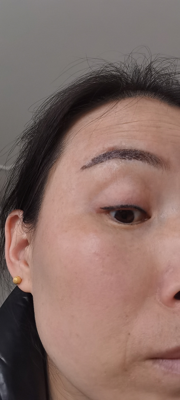 这是美瞳线补色后,十一天都不掉痂,结痂很厚,掉后就是一节有一节没有