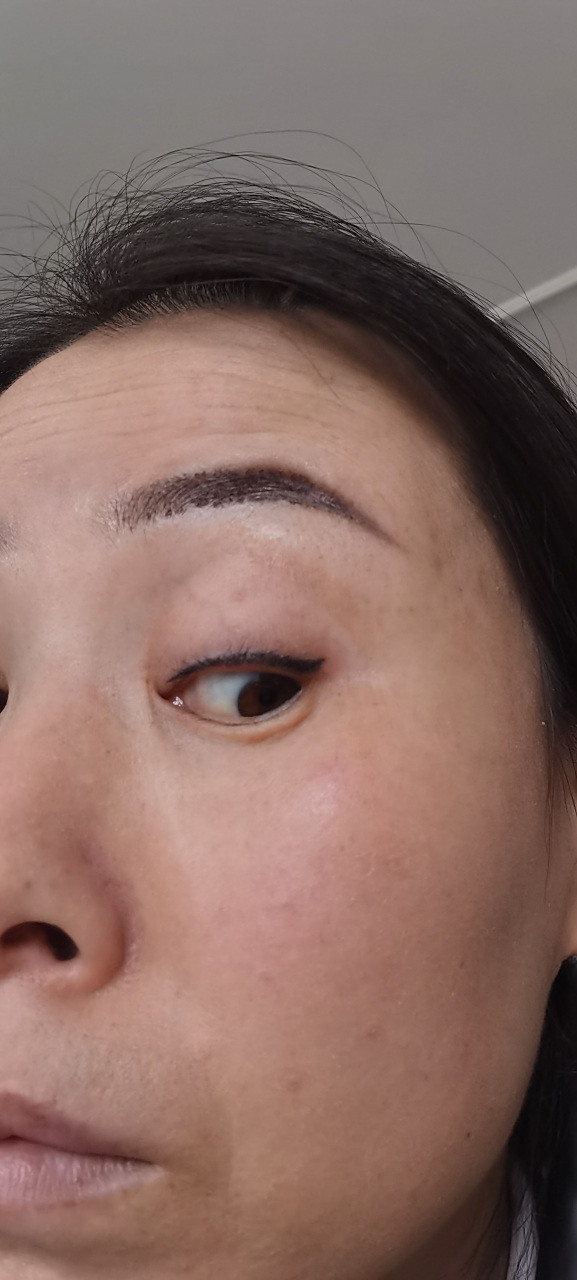 这是美瞳线补色后,十一天都不掉痂,结痂很厚,掉后就是一节有一节没有