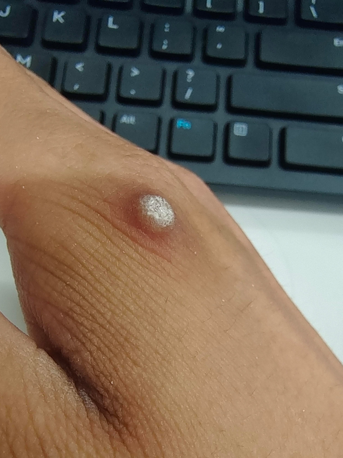 手上长了一个包!