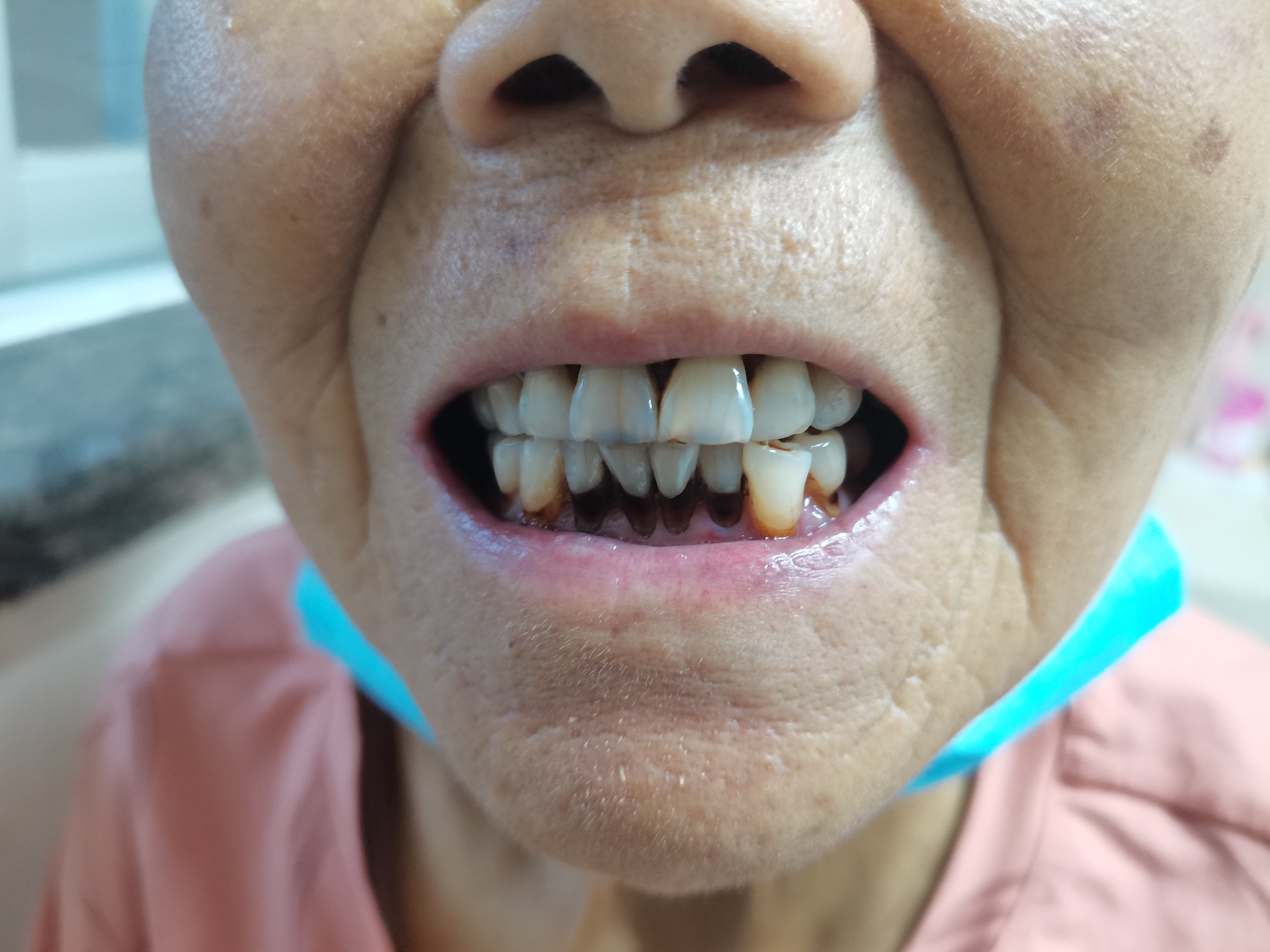 干燥综合征患者的口干,程度进行性加重,喝水不能缓解,患者每吃一口