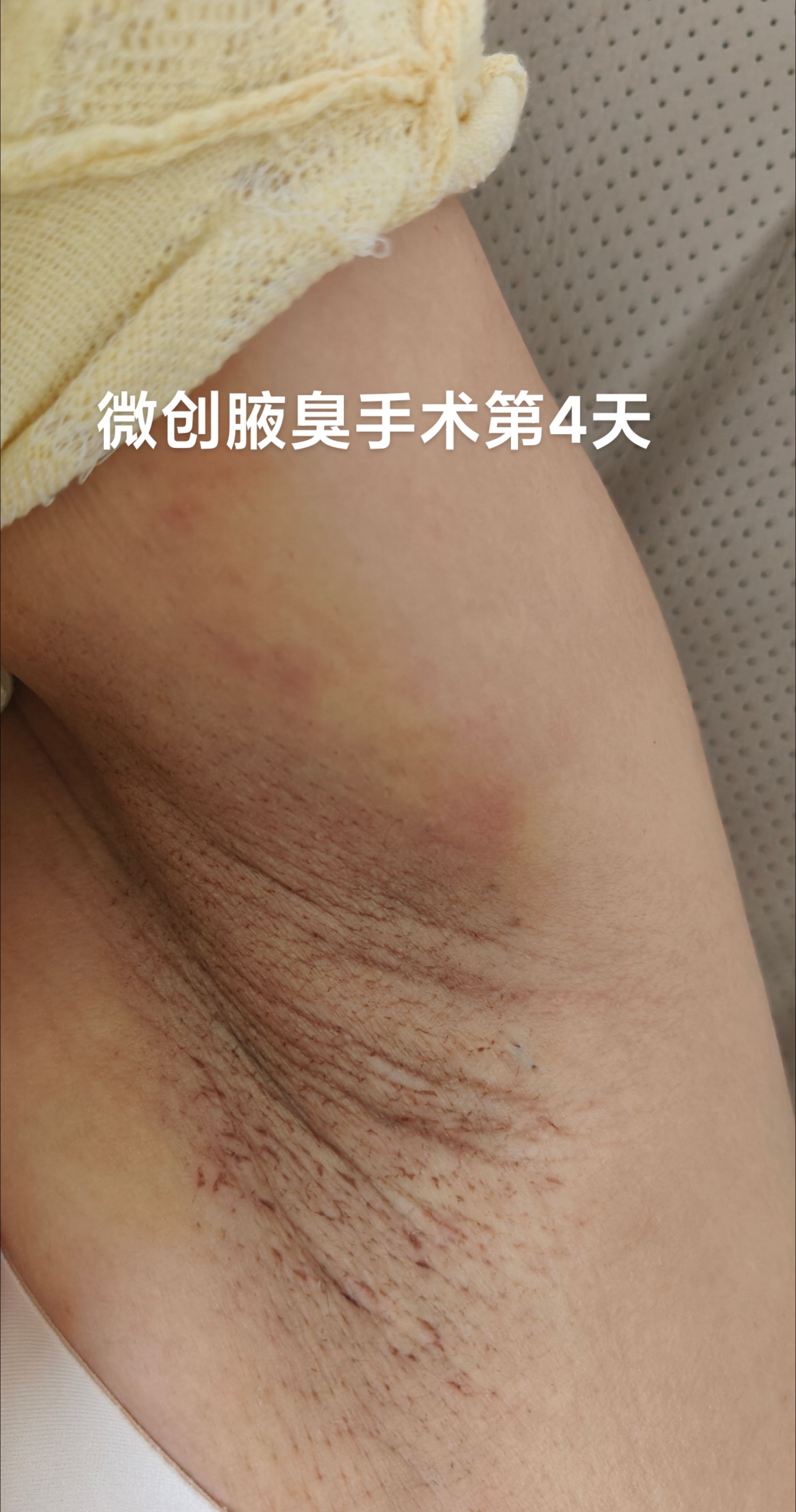 多汗症# #腋臭#狐臭# 患者因腋臭于10年前在他院行腋下汗腺清除术术 