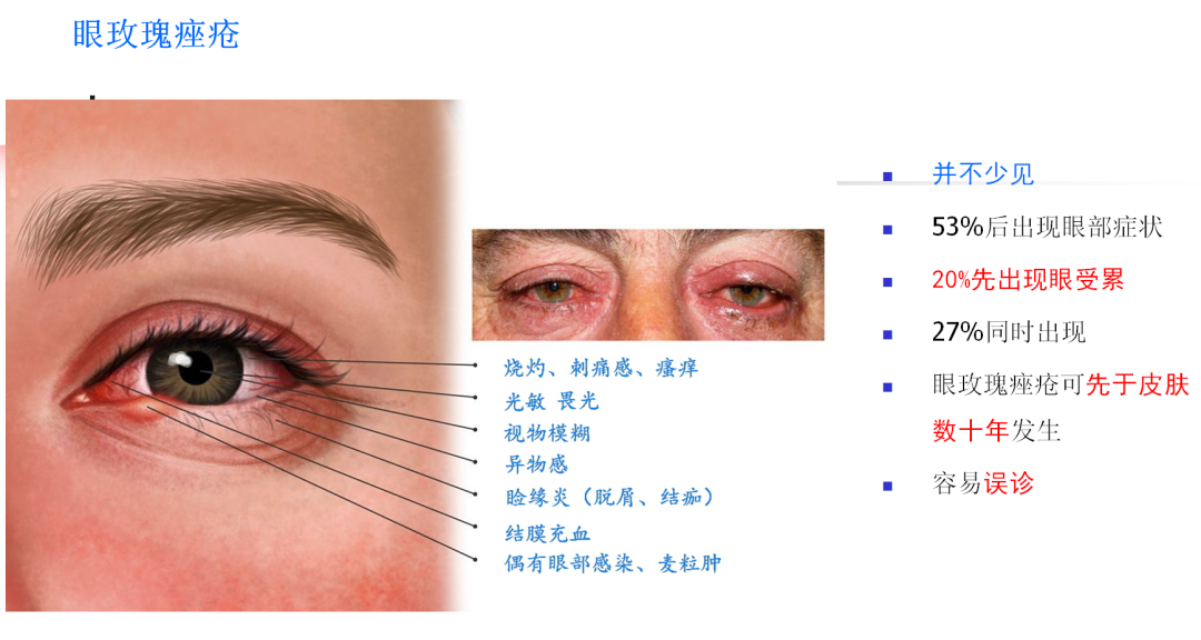 16 玫瑰痤疮,又称为酒渣鼻,是一种常见的损容性皮肤病.