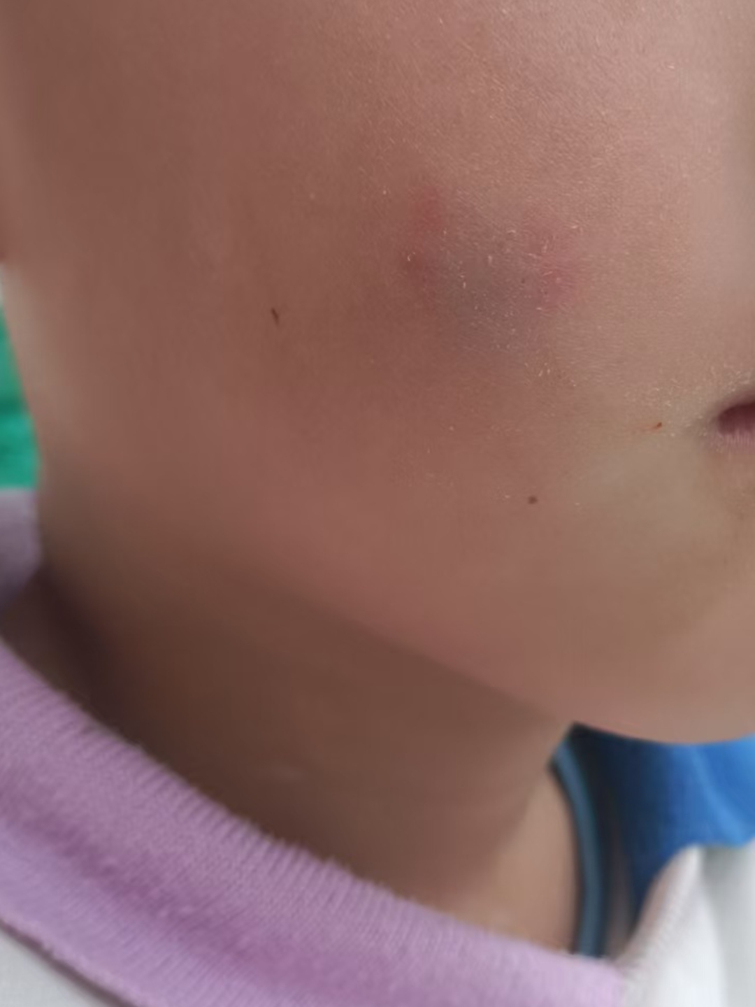 孩子把小朋友咬了,都发紫了,也有点破皮,要不要打破伤风?