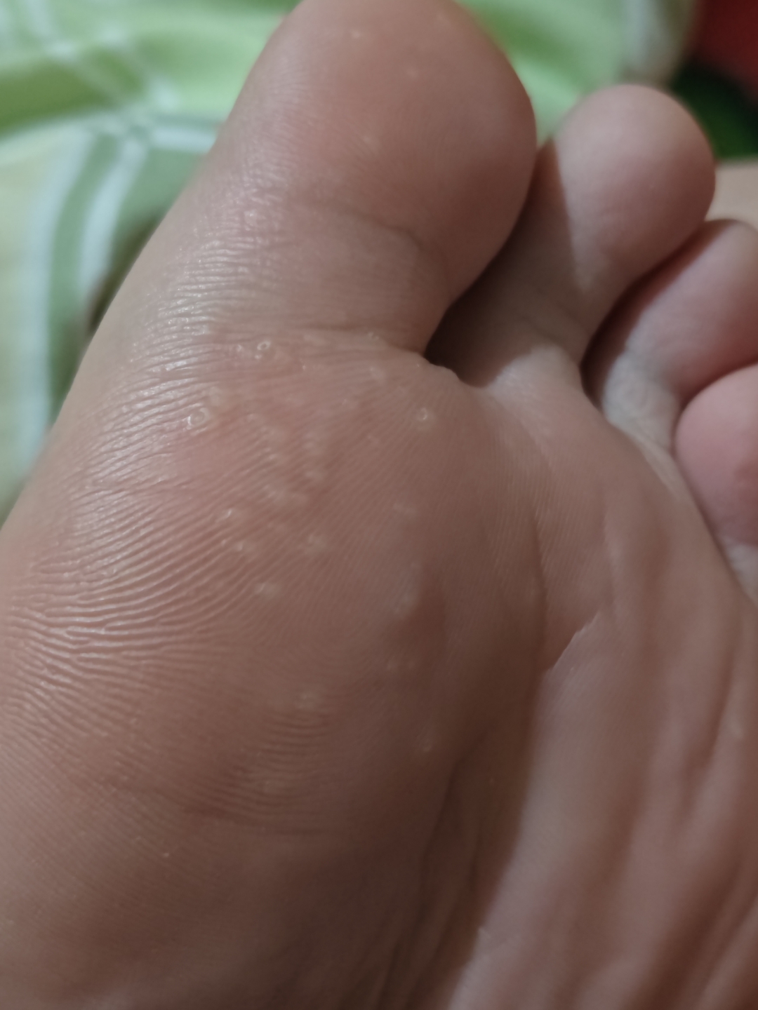 请问脚上长的这种半透明的硬硬的小水泡是什么呀?