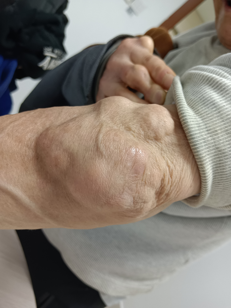 长了痛风石,只能手术治疗吗,能根治吗?