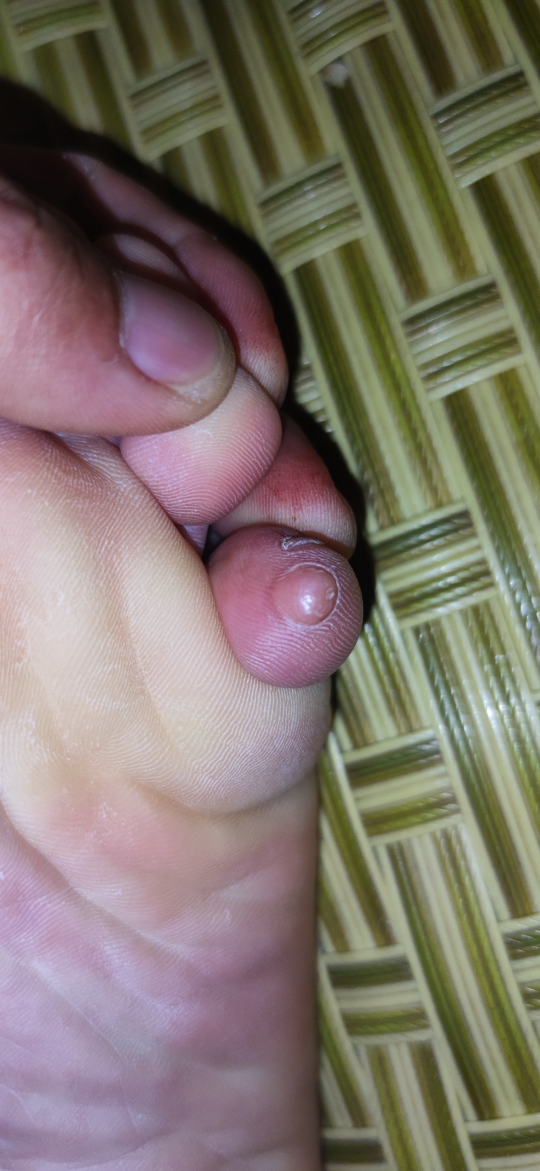 脚趾头长肉球是什么情况