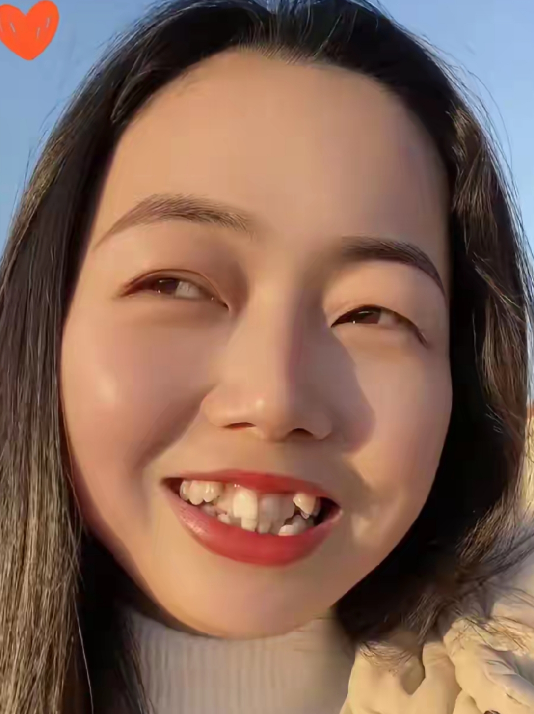 牙齿不齐不仅拉低颜值,还容易藏污纳垢,影响咀嚼