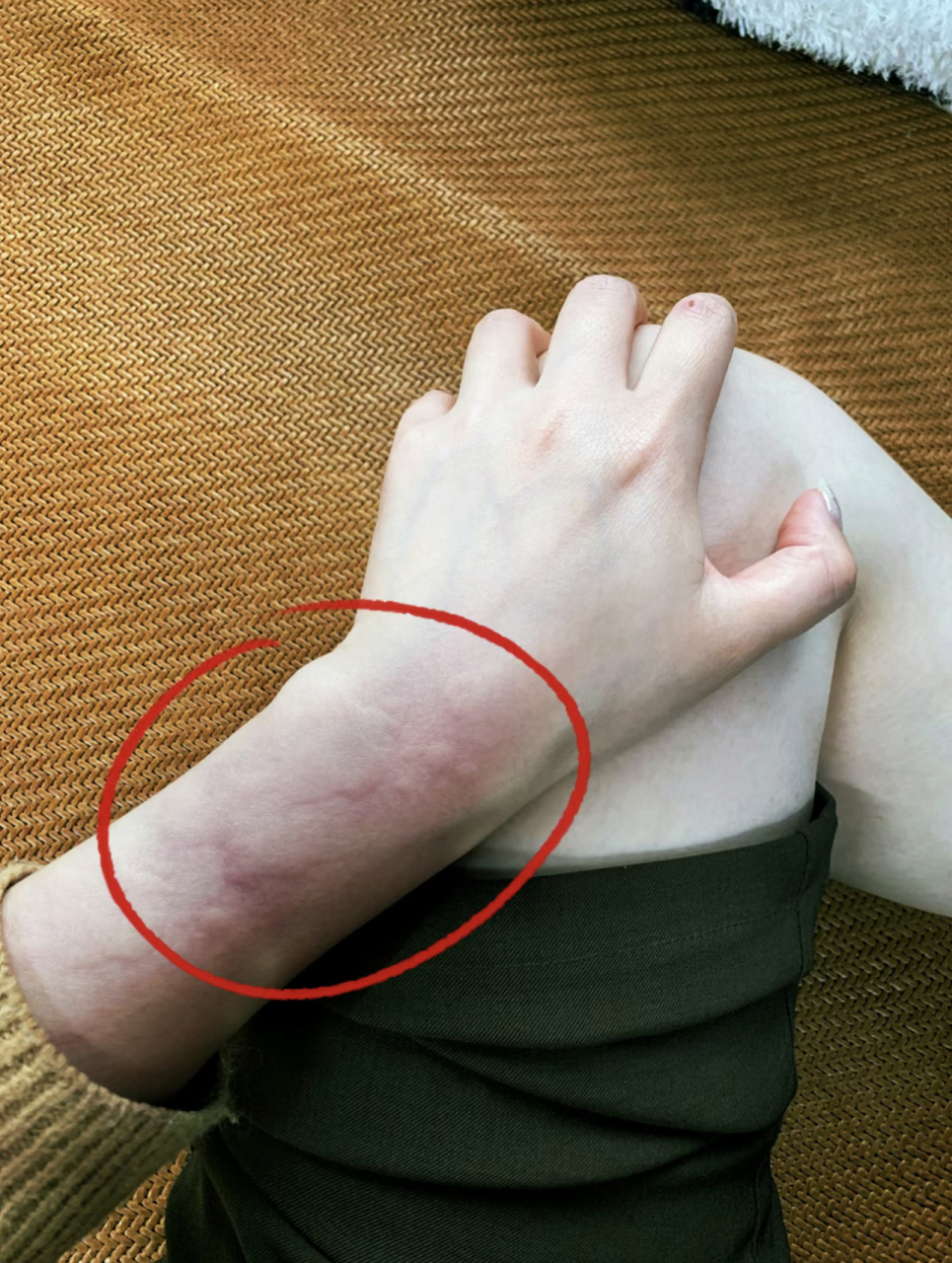 荨麻疹反复发作,一个方子送给你,让荨麻疹不再见. 荨麻疹中医又称为瘾