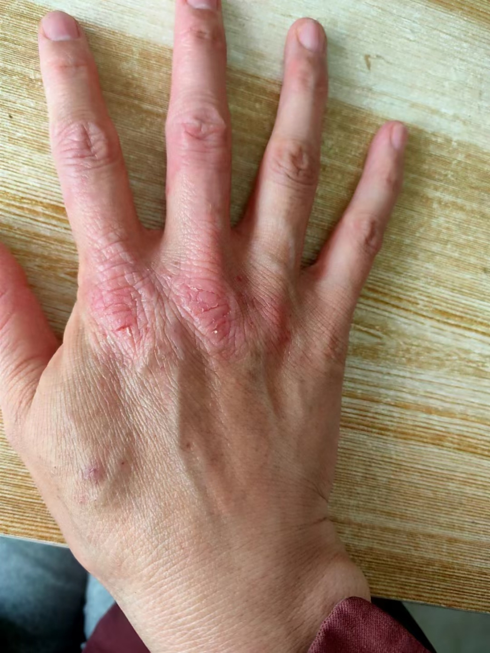 赵莉严重的干性湿疹,被困扰了十几年,反反复复被折