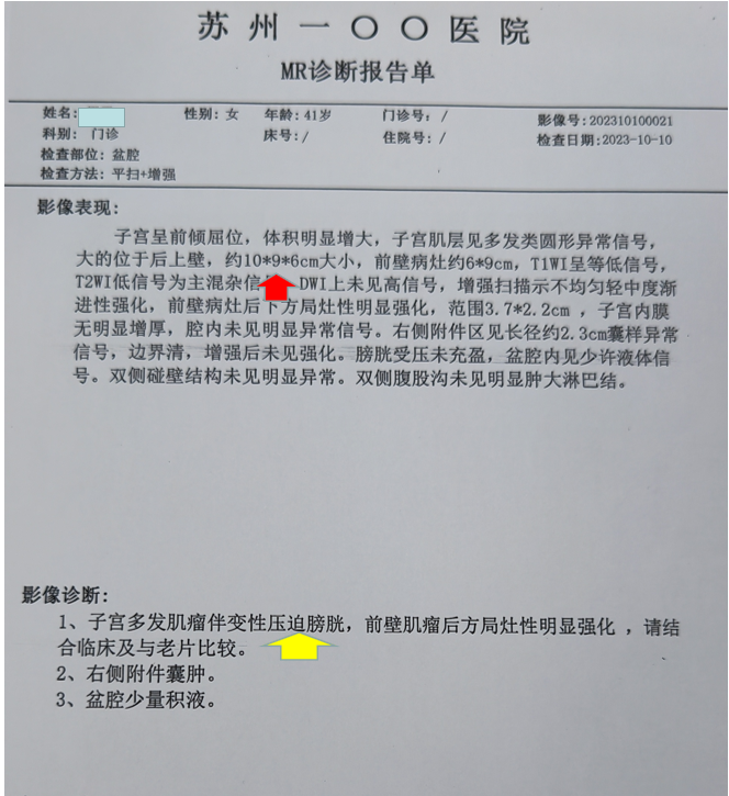 这是我们今天海扶刀治疗的一个多发性子宫肌瘤,患者女性,41岁,最大