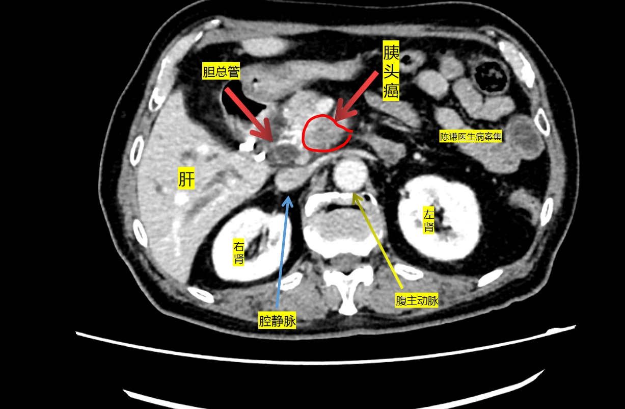 治疗的一个早期胰腺癌患者,病人84岁,因1个月前黄疸至当地医院检查