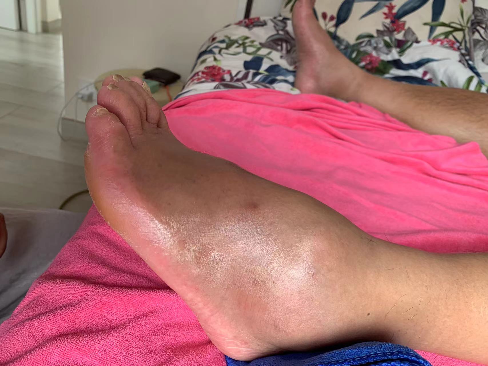 几十年的小儿麻痹症患者,他都不敢相信会脚落地走路,经过8次治疗,奇迹