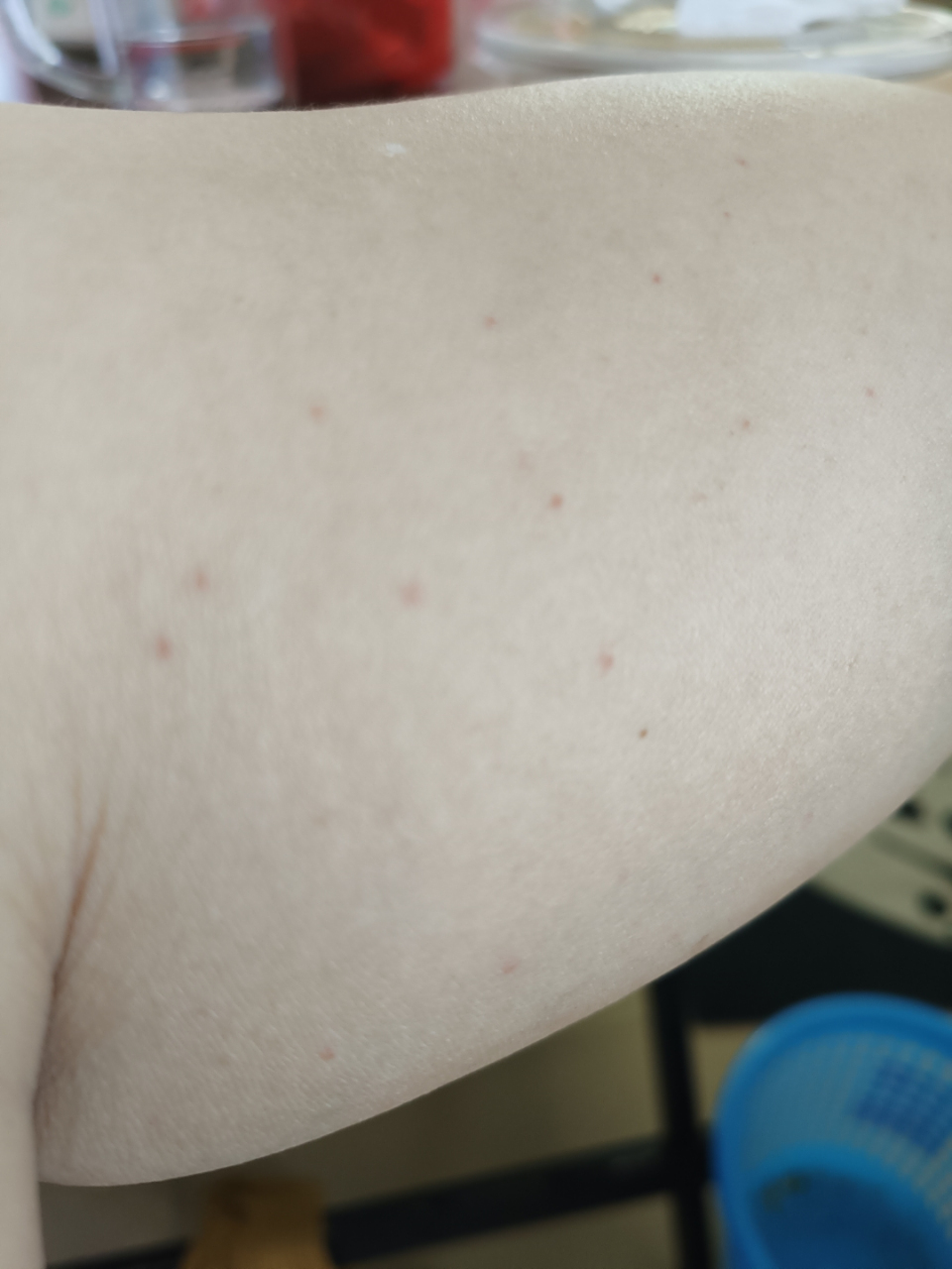 腿上起了好多这样的点点,不痛不痒是怎么回事呀