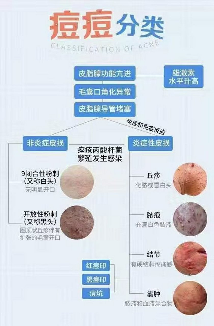 「深圳皮肤病医院「深圳肤康」痘痘的分型有很多种,治疗的方式也是