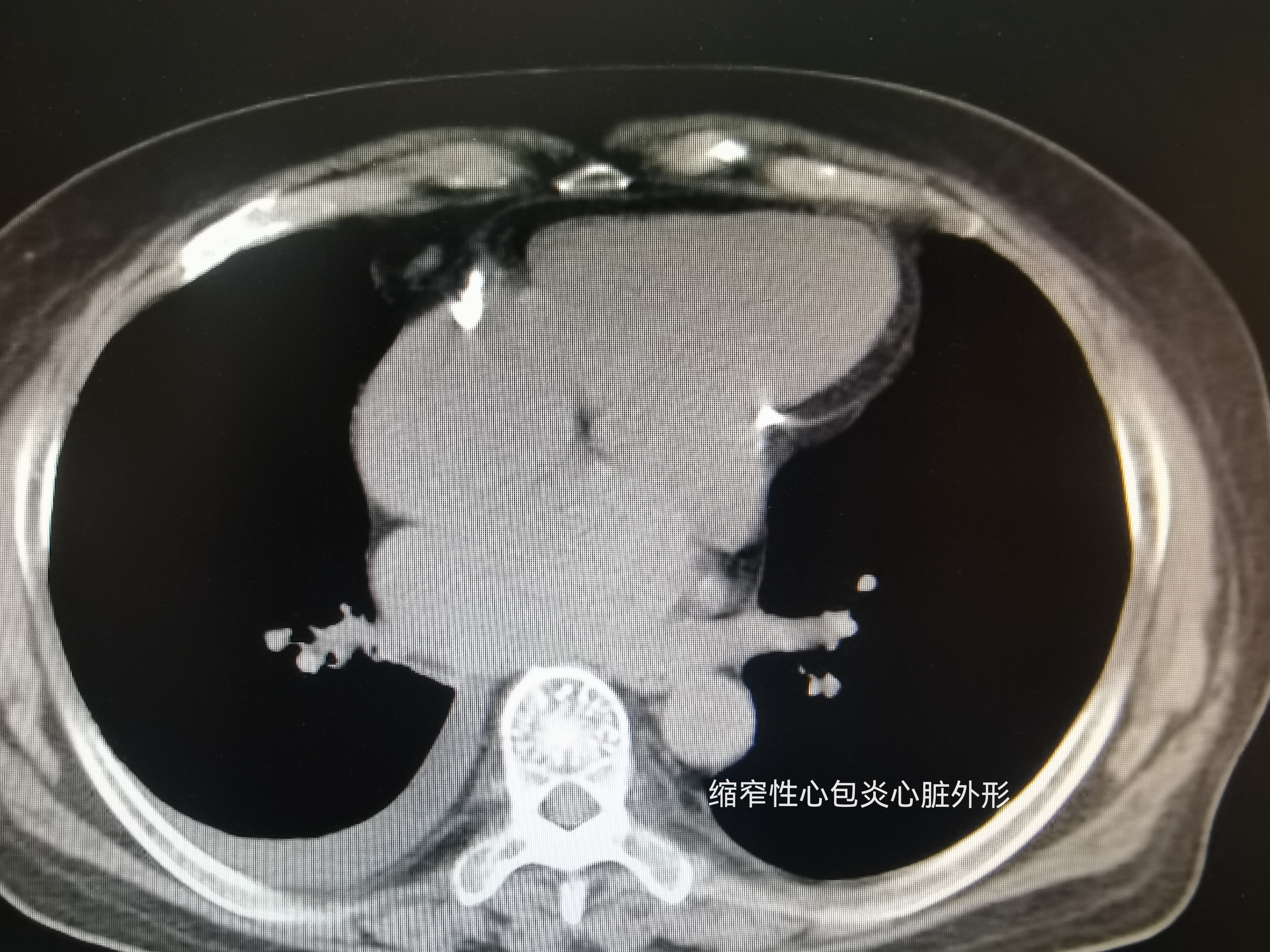 绞窄性心包炎图片