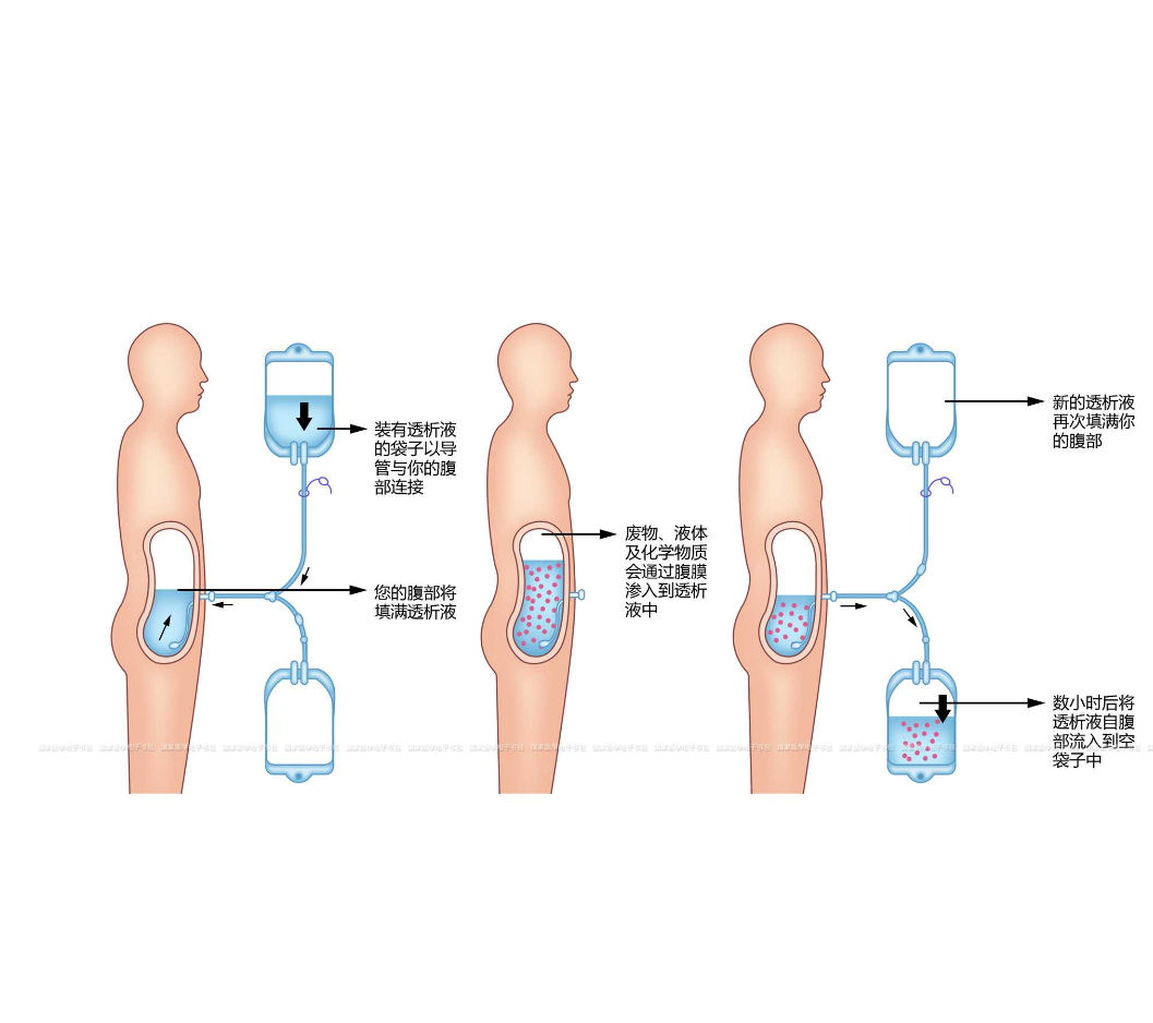 同时补充人体所需的某懈鼓 透析原理示意图腹膜透析示意图腹膜透析