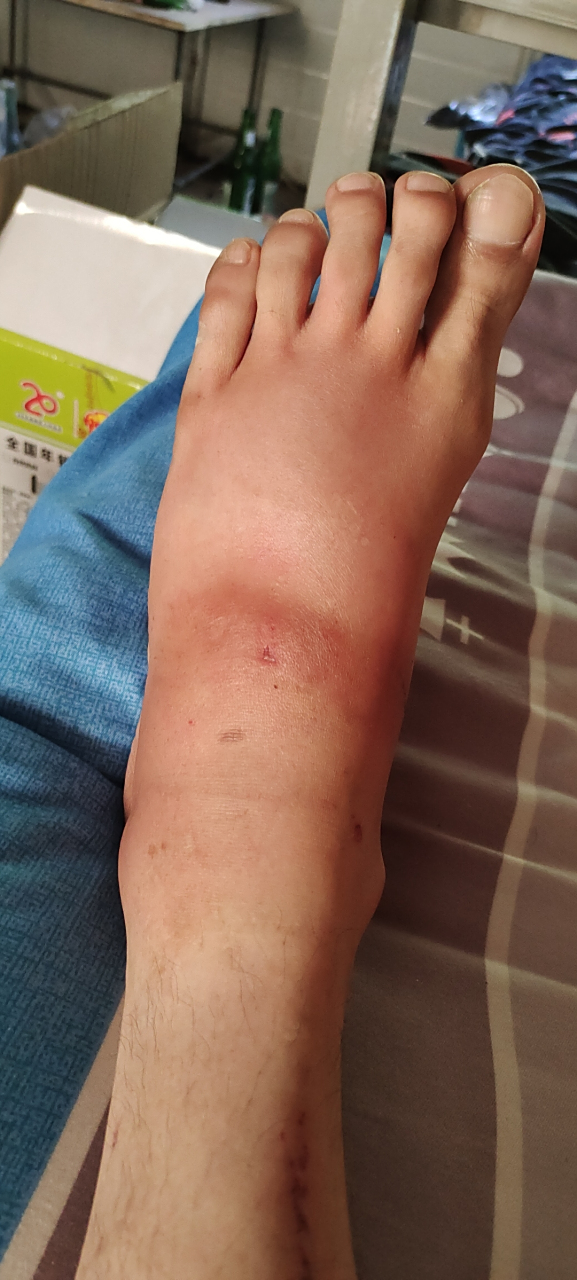 牛虻咬一口真疼真痒啊!