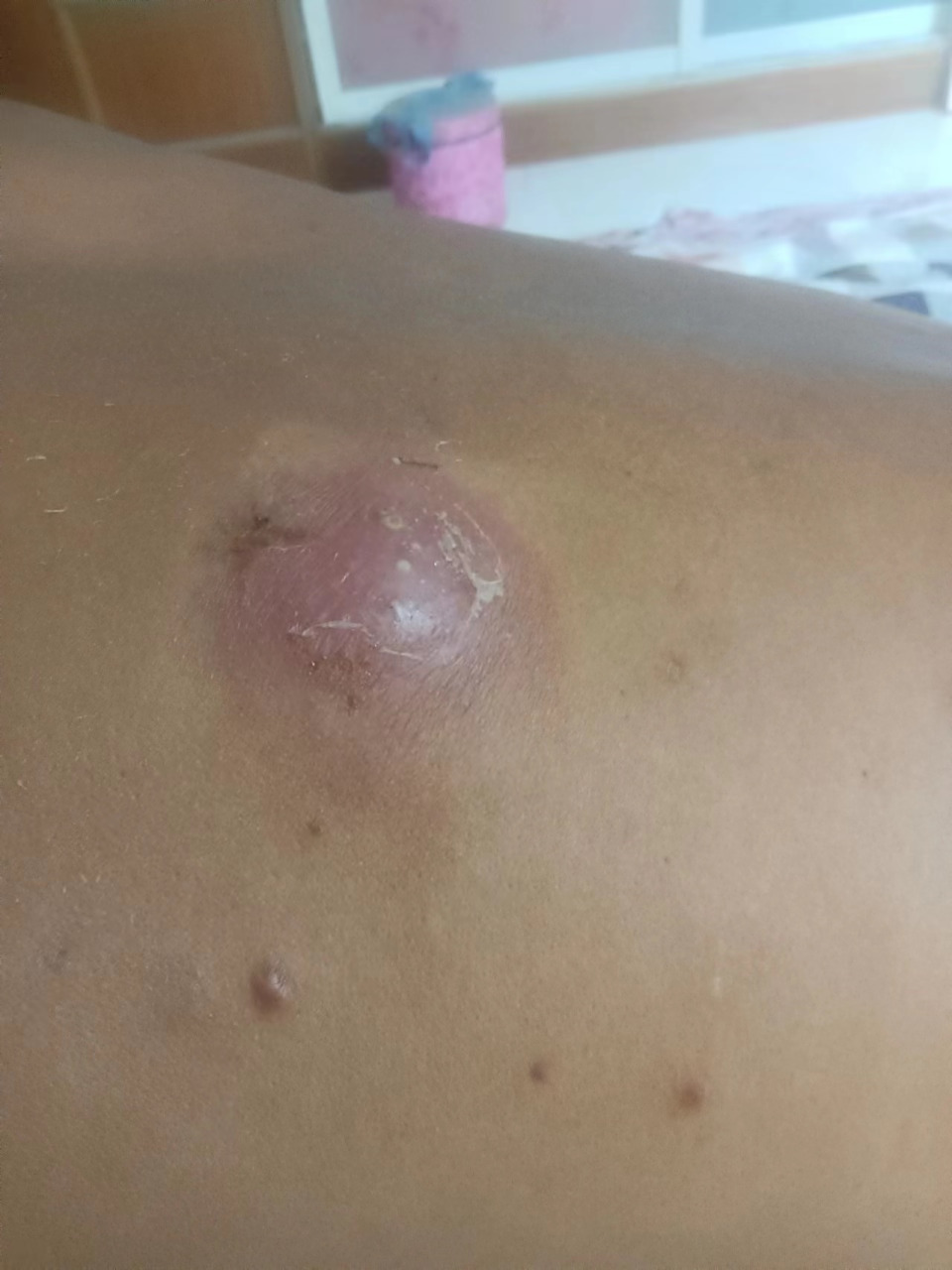 这么大的火疖子!谁有好办法给推荐一下!