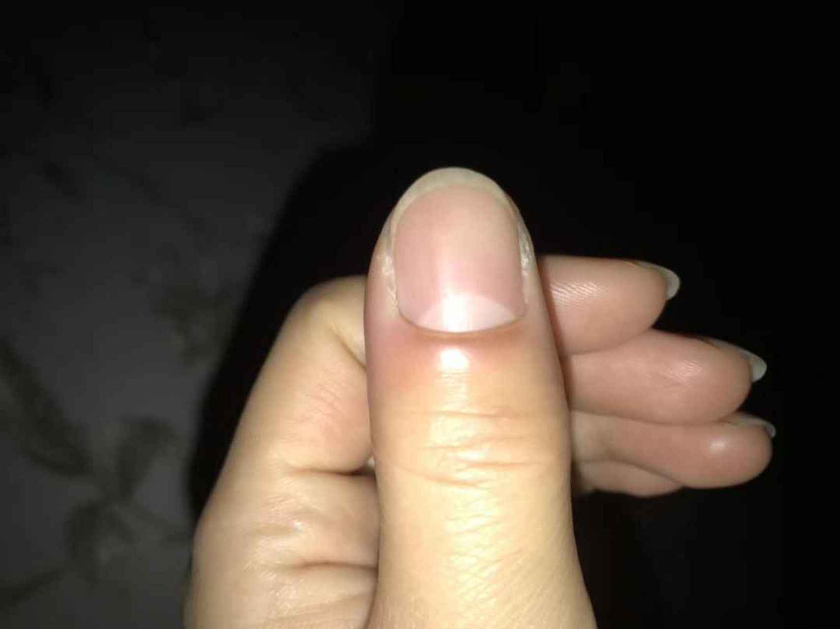 大拇指肿痛,麻木,是什么原因?