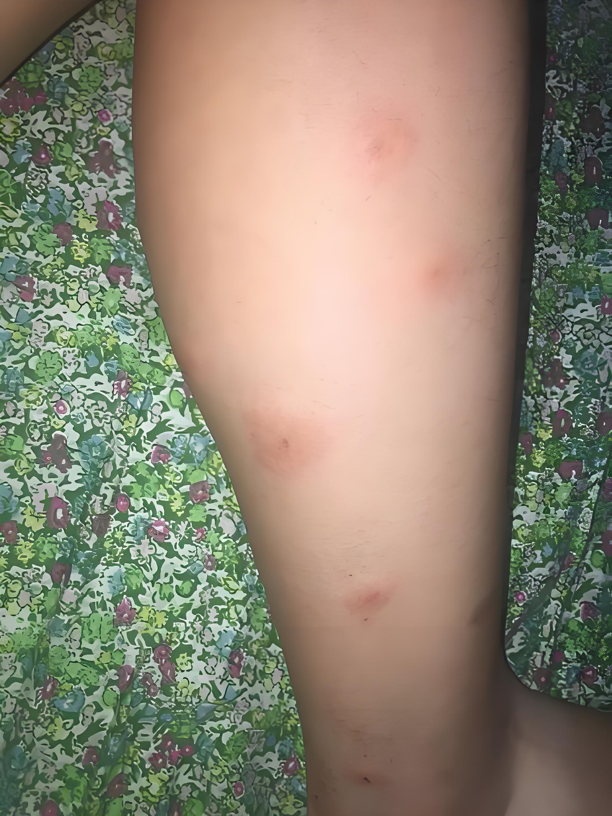 伏天潮湿闷热的天气太难熬了,出门被蚊子叮,在家被不知名的小飞虫叮咬