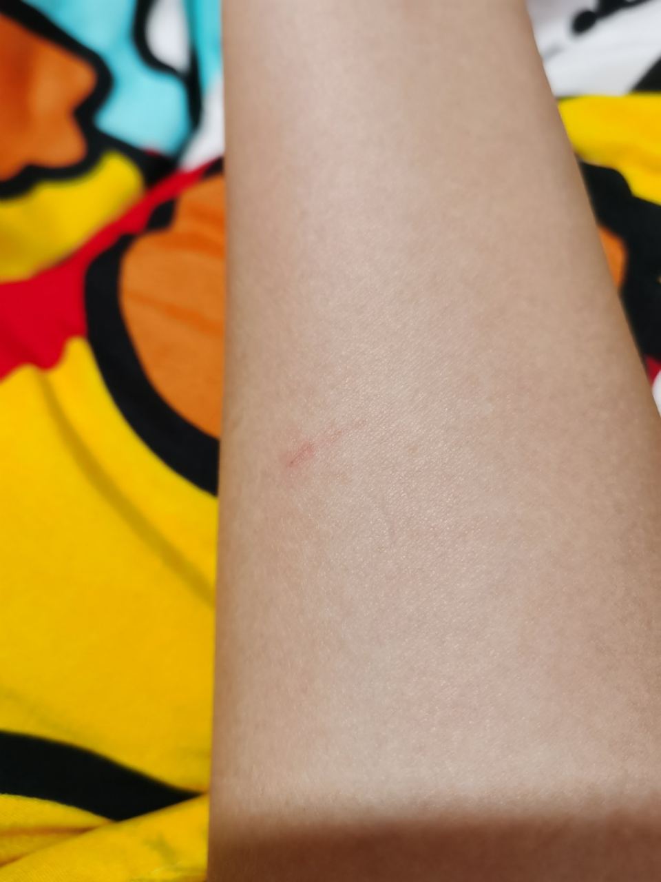 被路上很小的狗的抓子划了这么点细痕,需要打狂犬疫苗吗