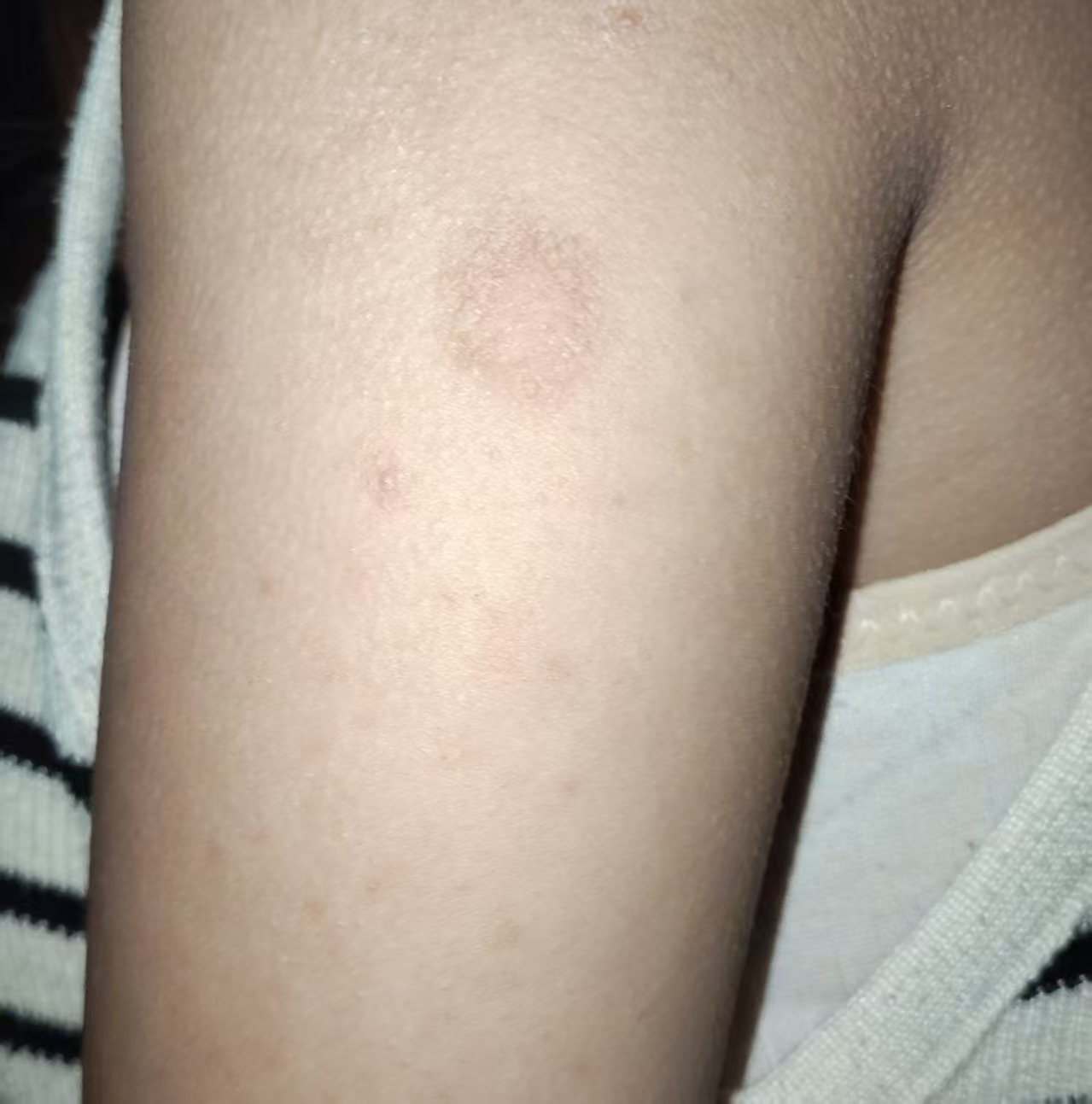 手臂上看见了一个圈圈癣 谁知道这是什么情况吗?