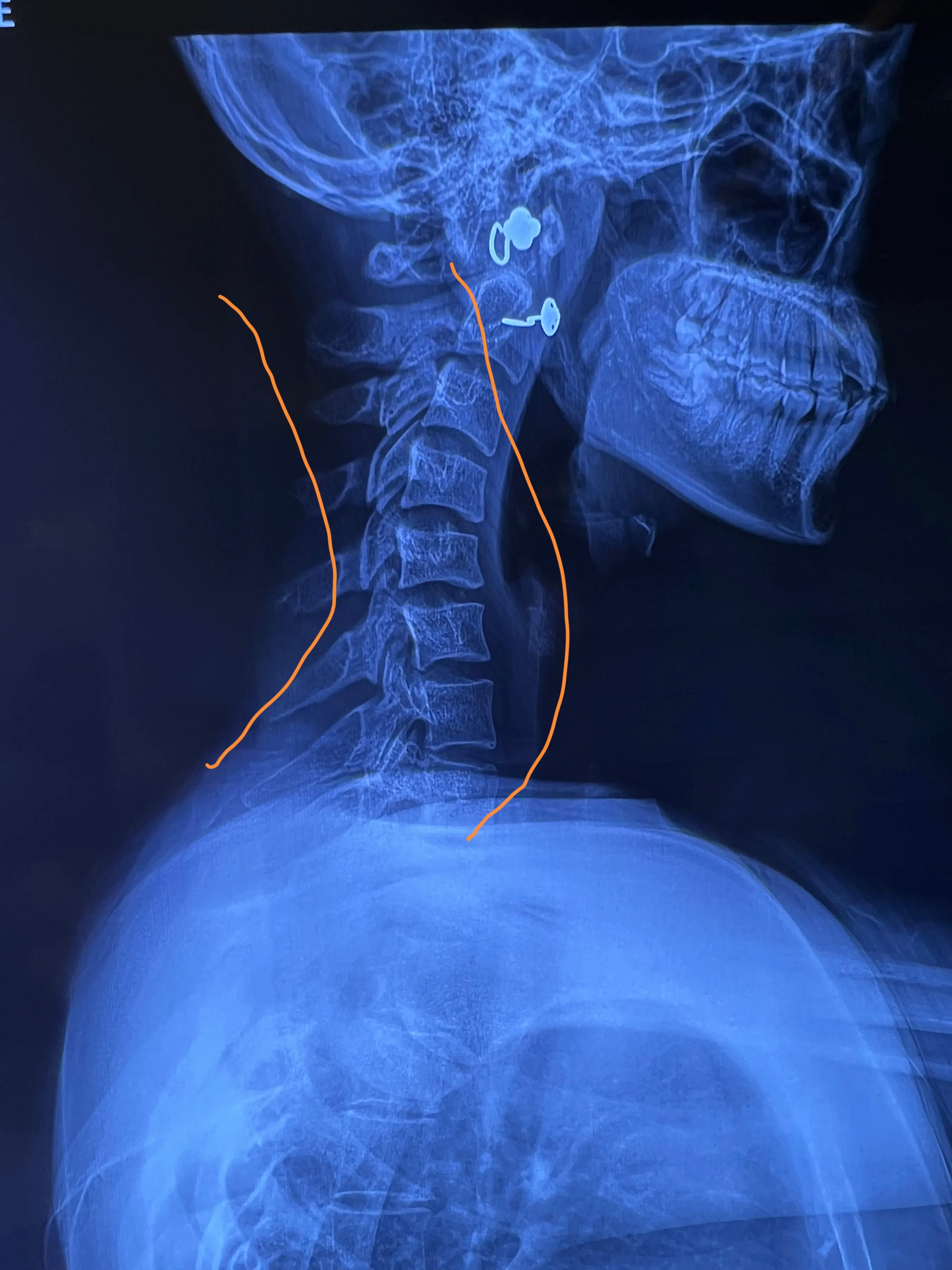 现在医学科技越来越先进了,比如这位24岁工厂流水线女孩的颈椎x光图