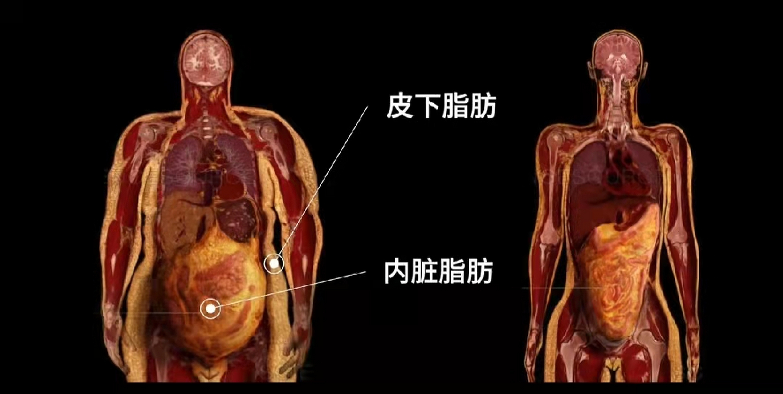 皮下脂肪和内脏脂肪图片