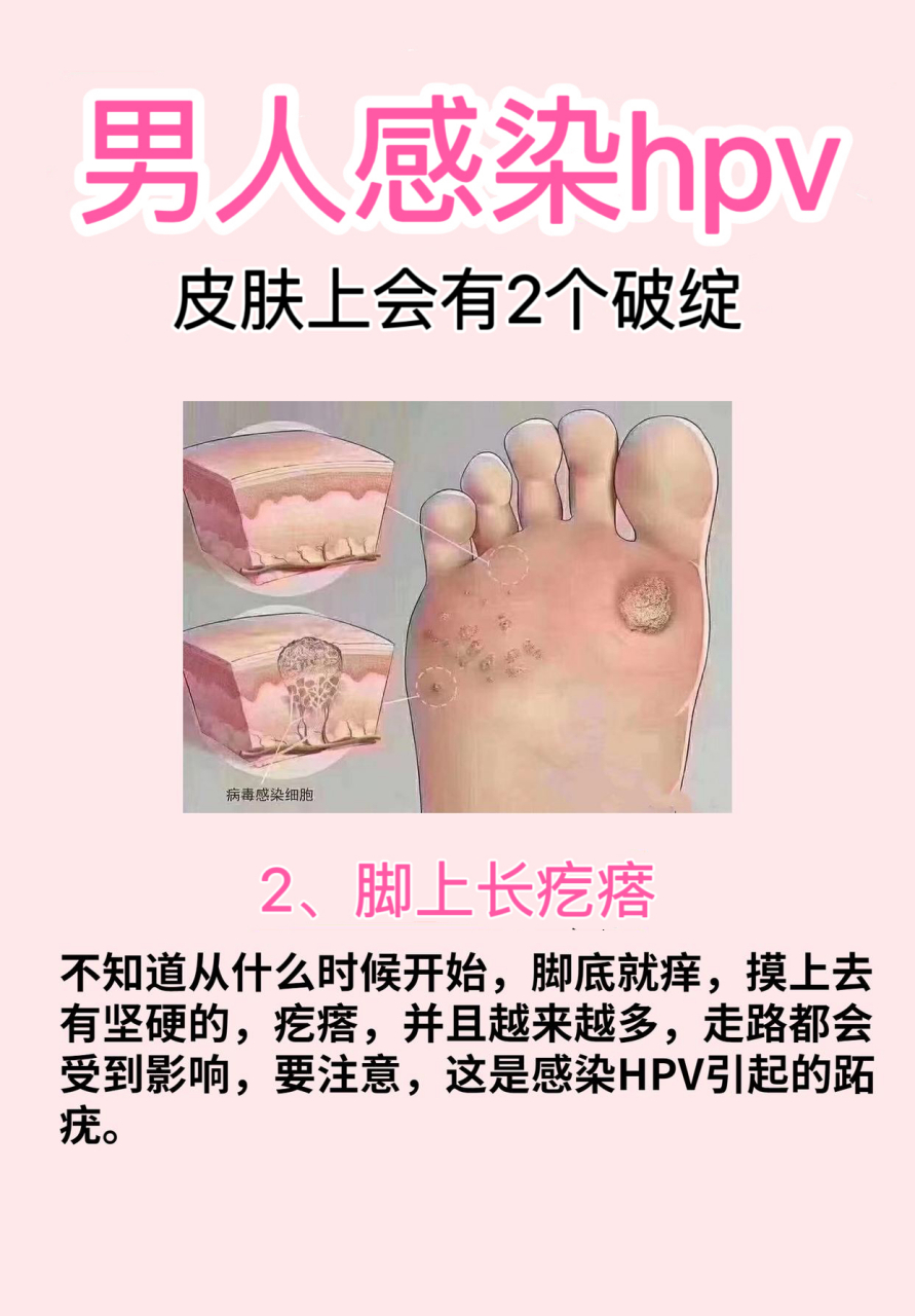 手和脚底痒长出"疙瘩",可能是hpv感染,可以对照自查看看!