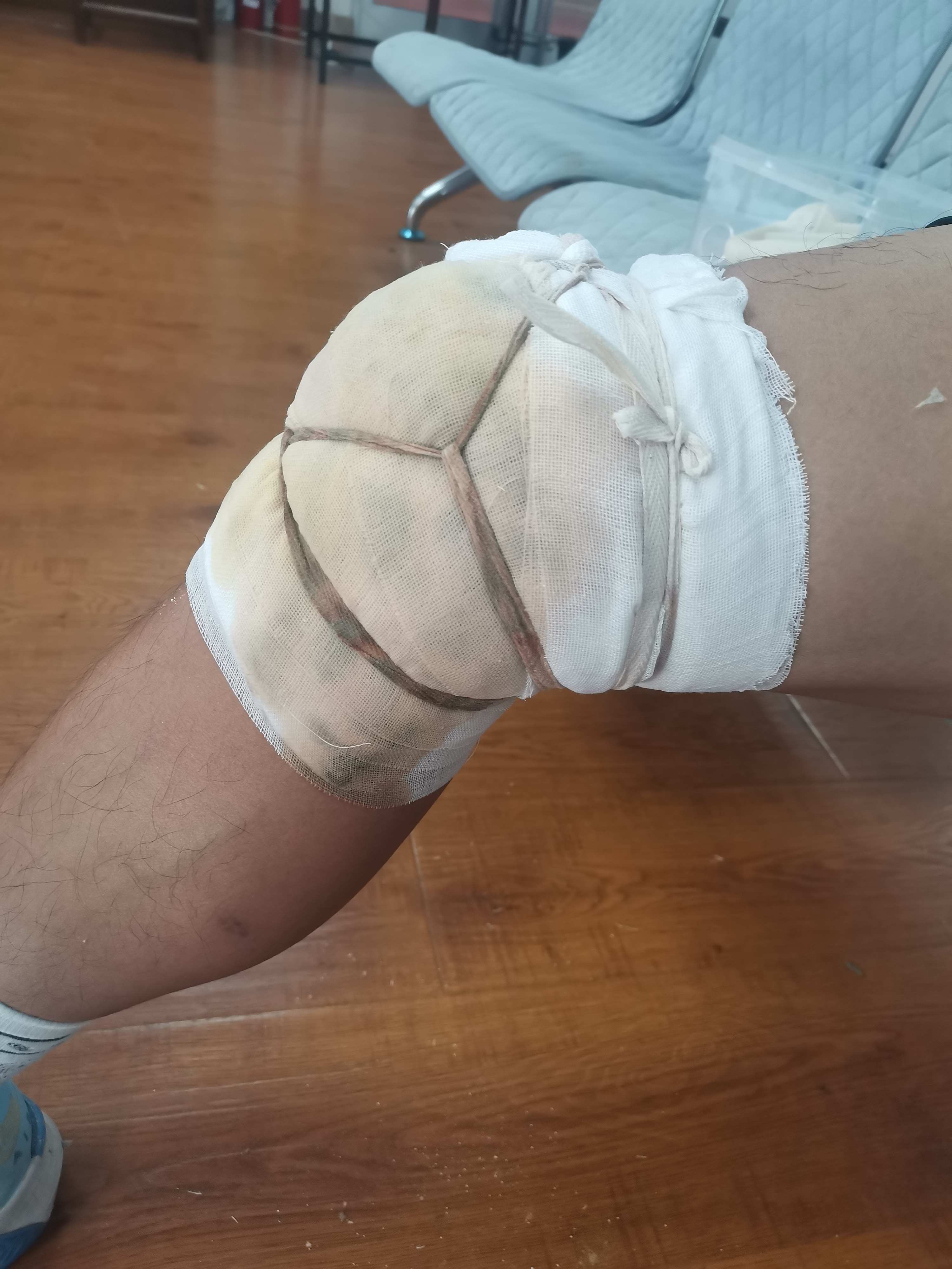 重庆骨元堂中医湿敷包药# #观膝盖打石膏图片 真实膝盖包扎真实图片