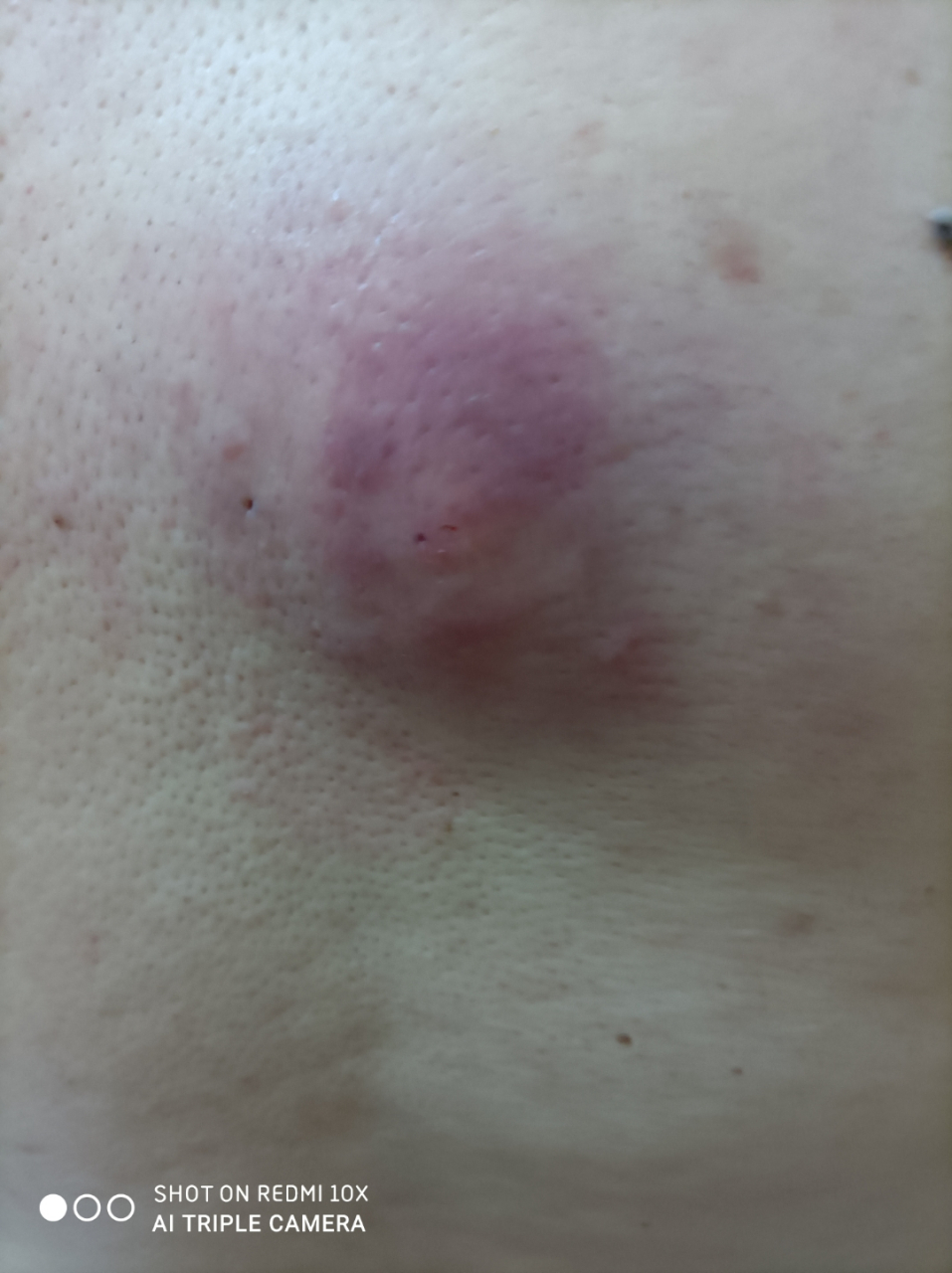 后背起了个大闷头,怎么办