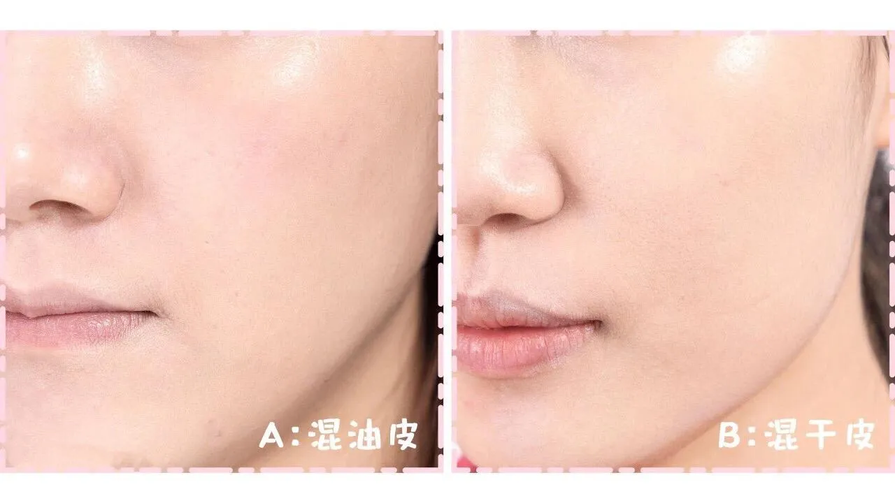 [嘿哈]油皮和干皮是由于皮肤的油脂分泌和水分含量不同而导致的.